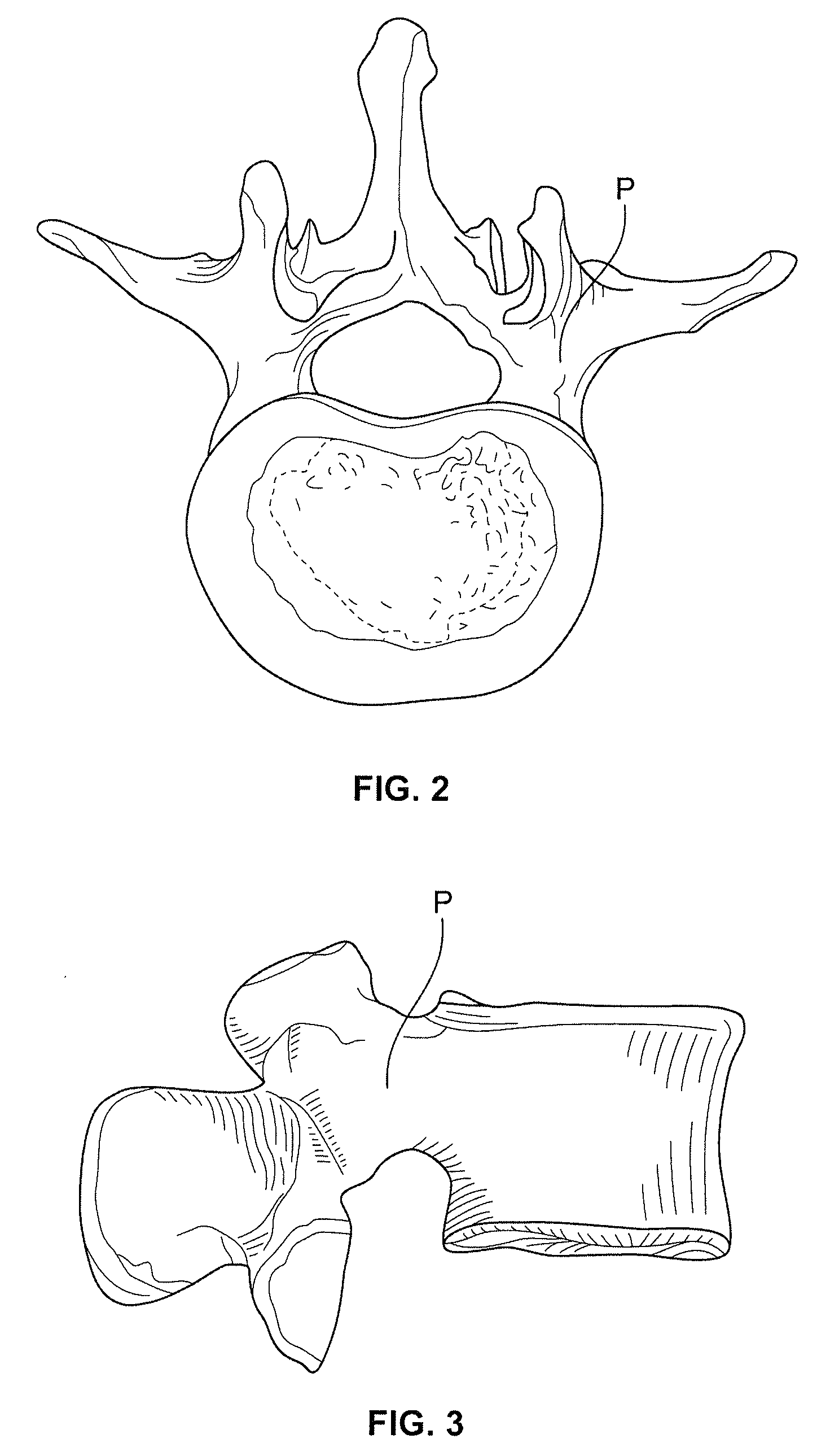 Devices and methods for intervertebral therapy