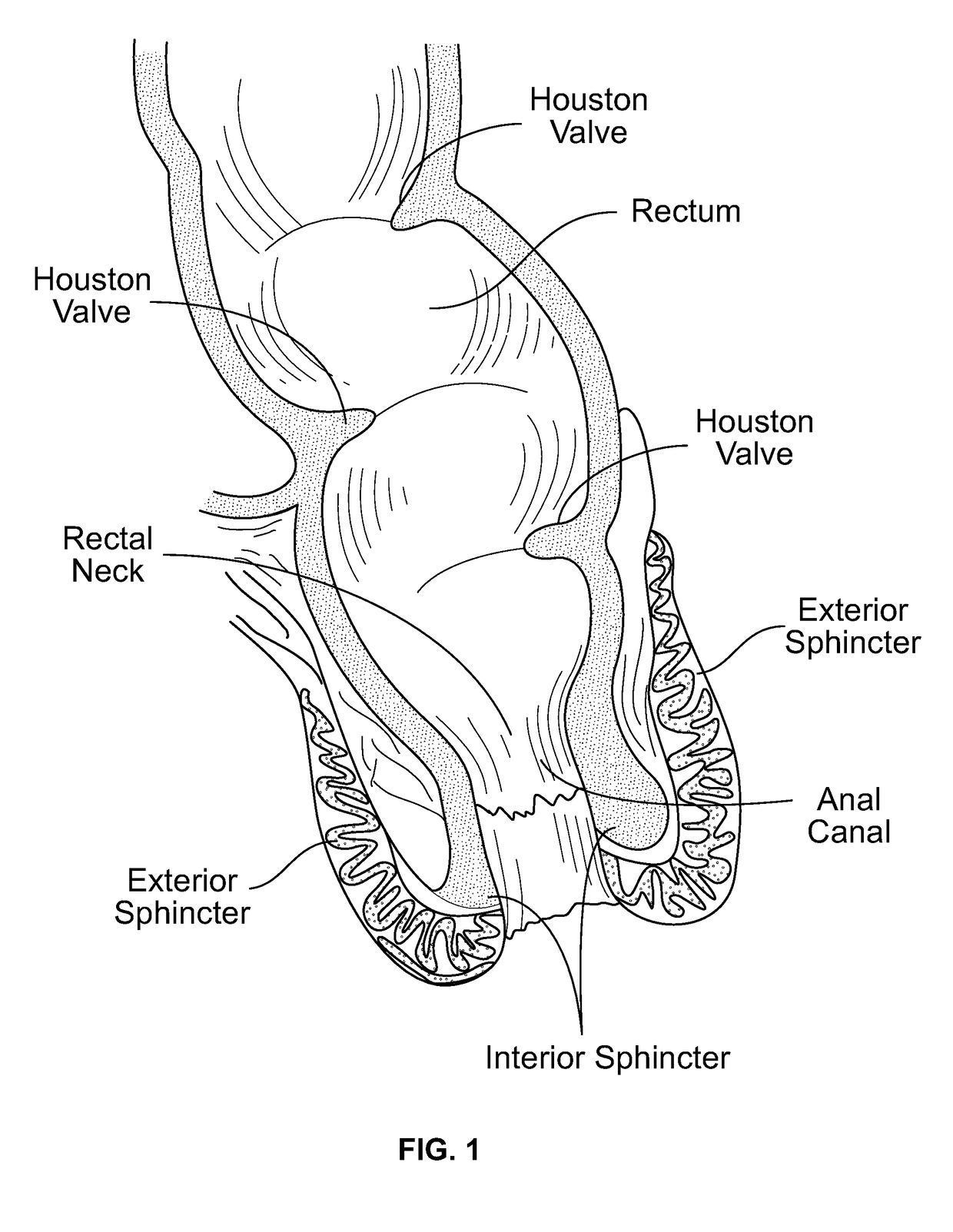 Device for controlling fecal incontinence