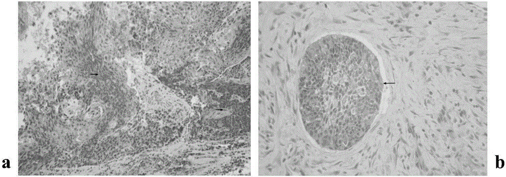 LAMP (loop-mediated isothermal amplification) primer group CK7-18 for rapid detection of lymphatic metastasis of head and neck squamous cell carcinoma (HNSCC)