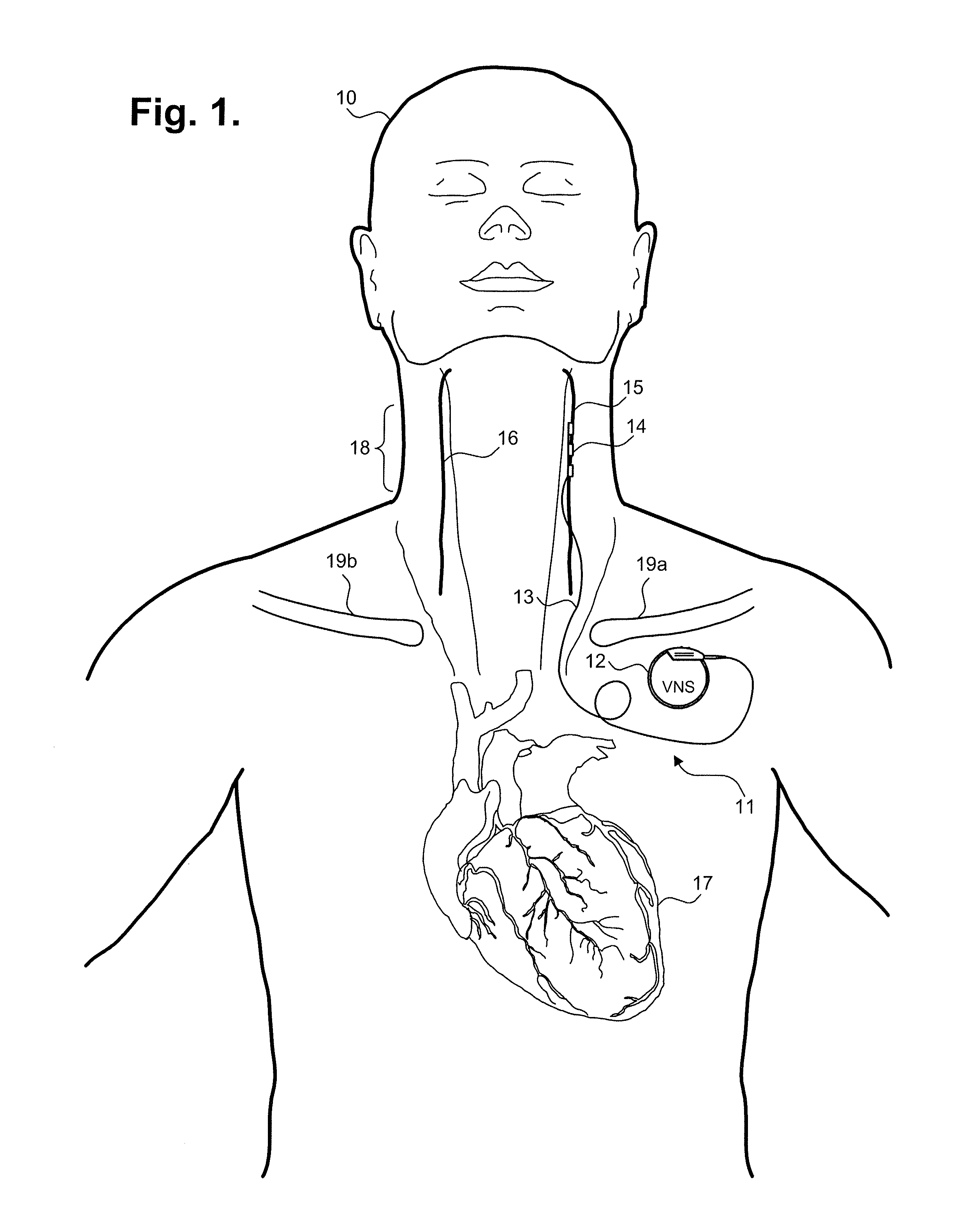 Implantable device for providing electrical stimulation of cervical vagus nerves for treatment of chronic cardiac dysfunction with leadless heart rate monitoring