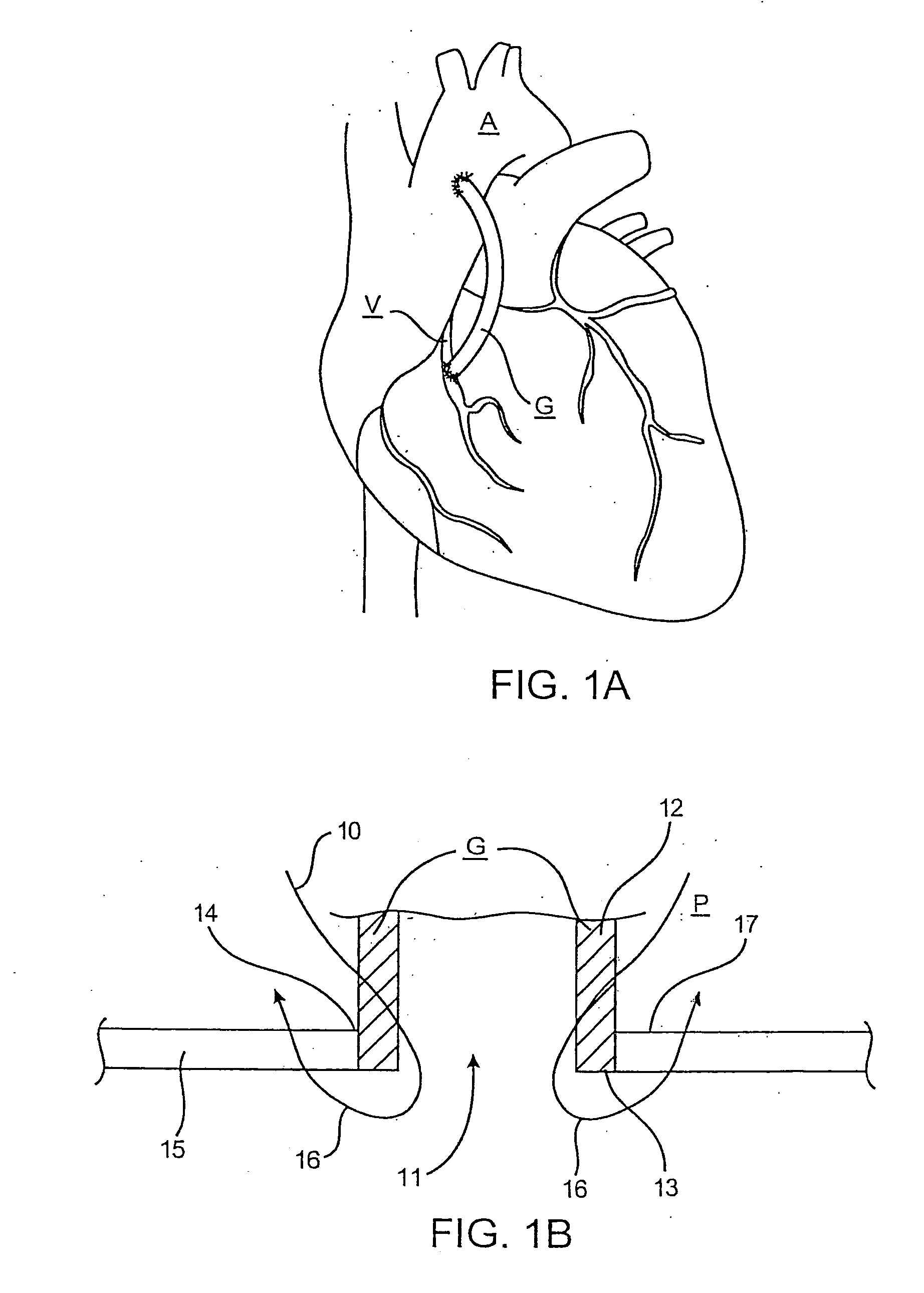 Device and method for performing end-to-side anastomosis