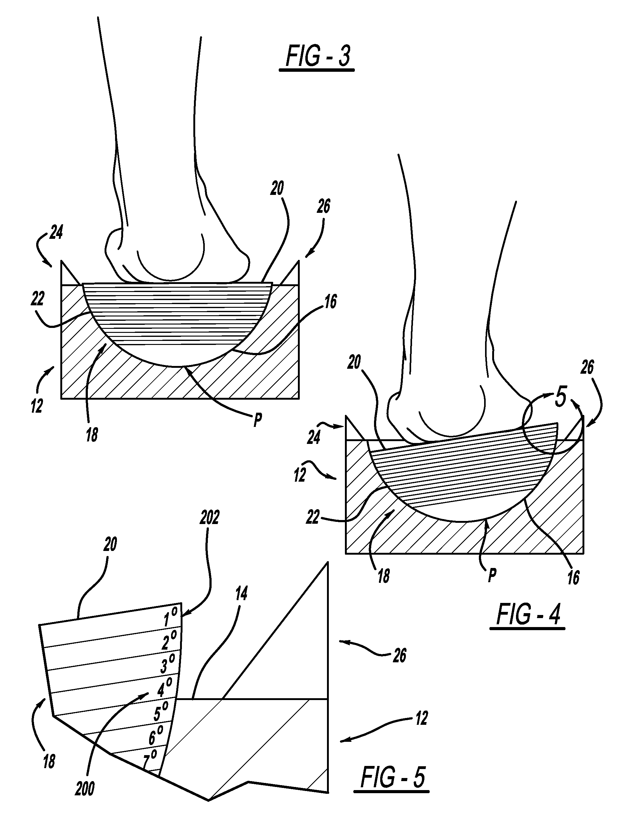 Measurement system for varus/valgus angles in feet