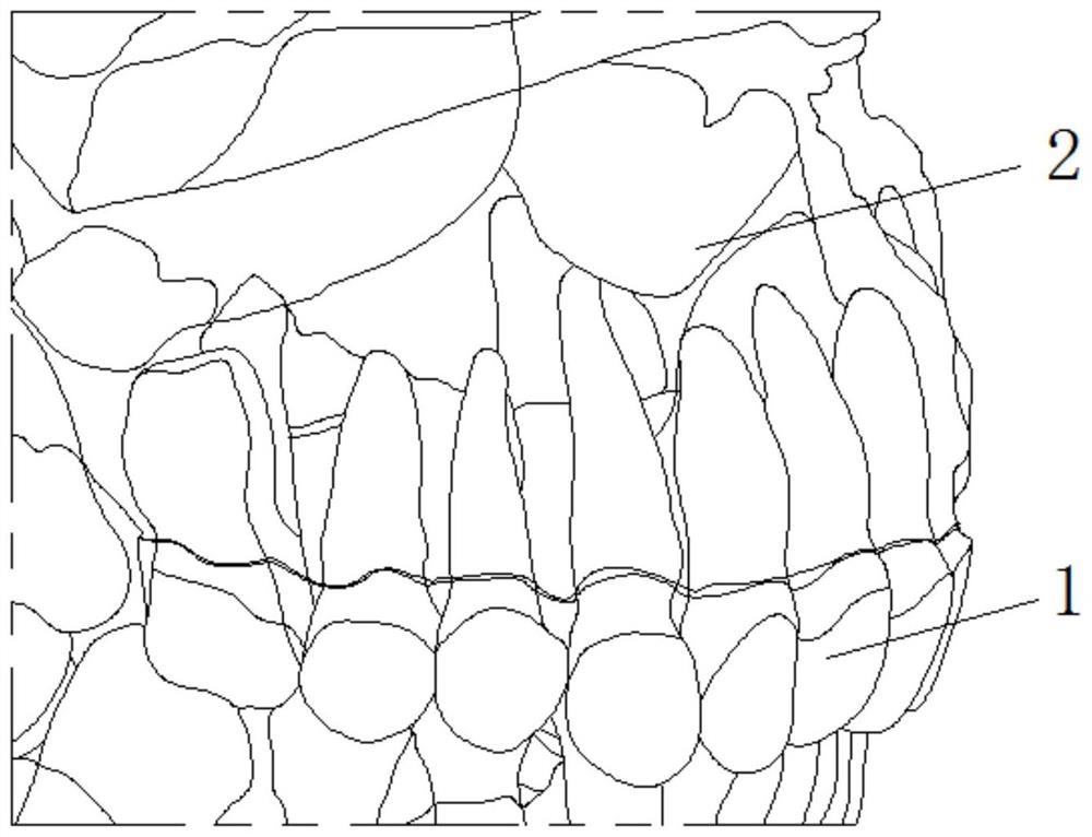 Design method of fixed anchorage for assisting invisible correction