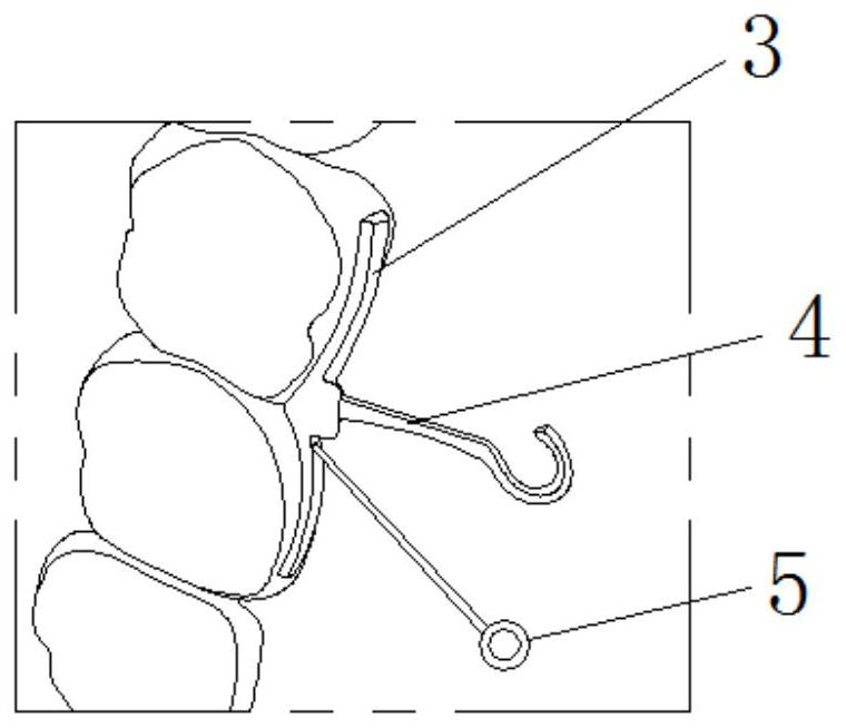 Design method of fixed anchorage for assisting invisible correction