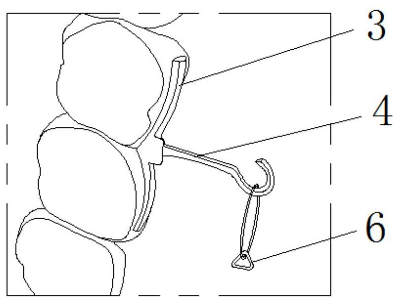 Design method of fixed anchorage for assisting invisible correction