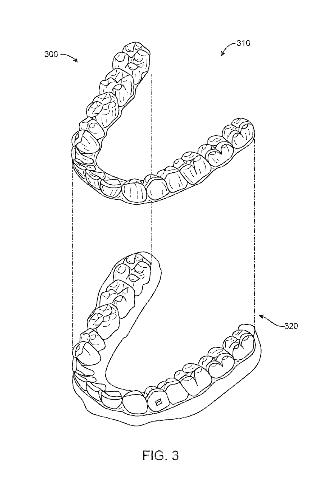 Treatment of temperomandibular joint dysfunction with aligner therapy