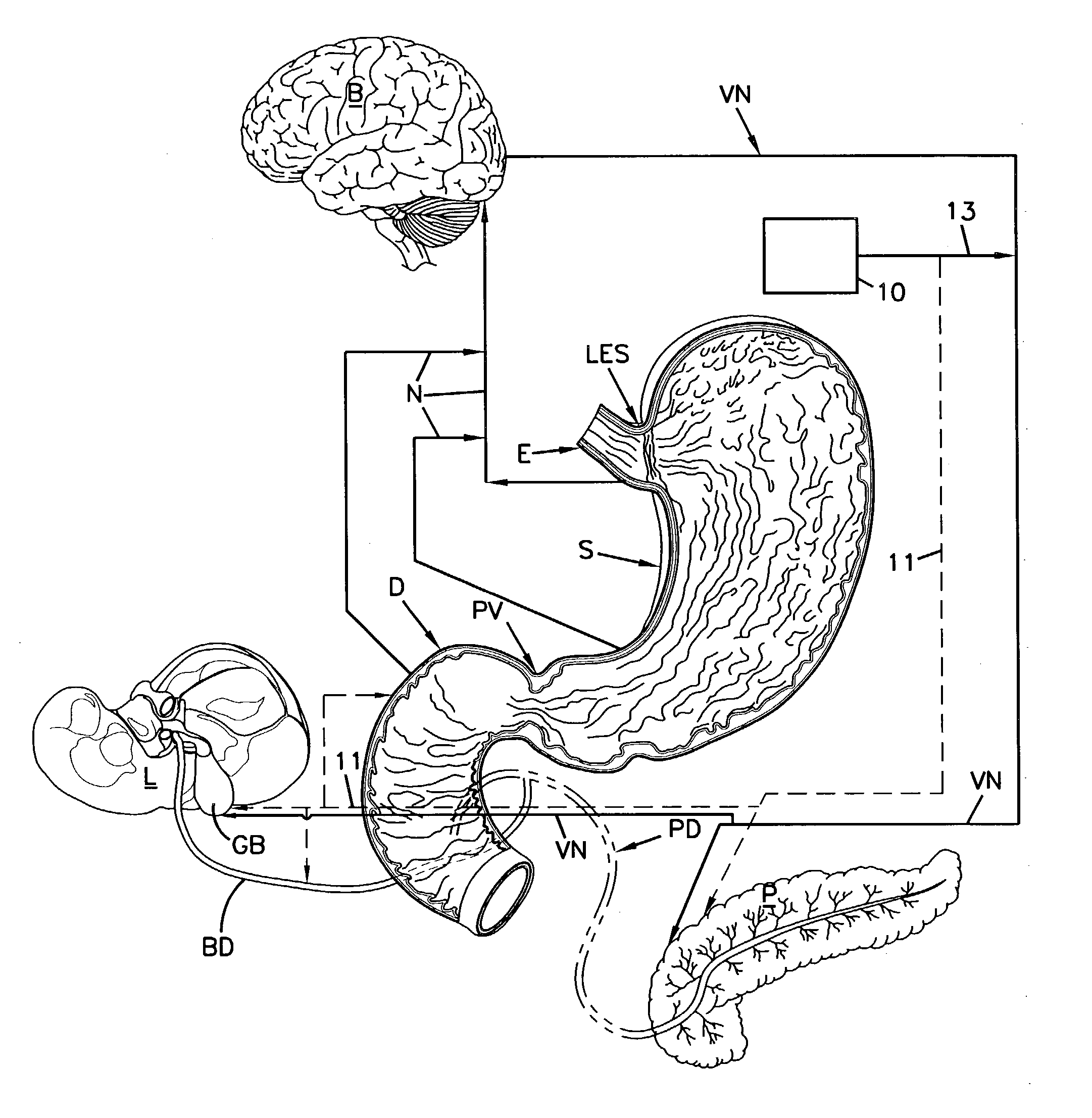 Method and apparatus for treatment of gastro-esophageal reflux disease (GERD)