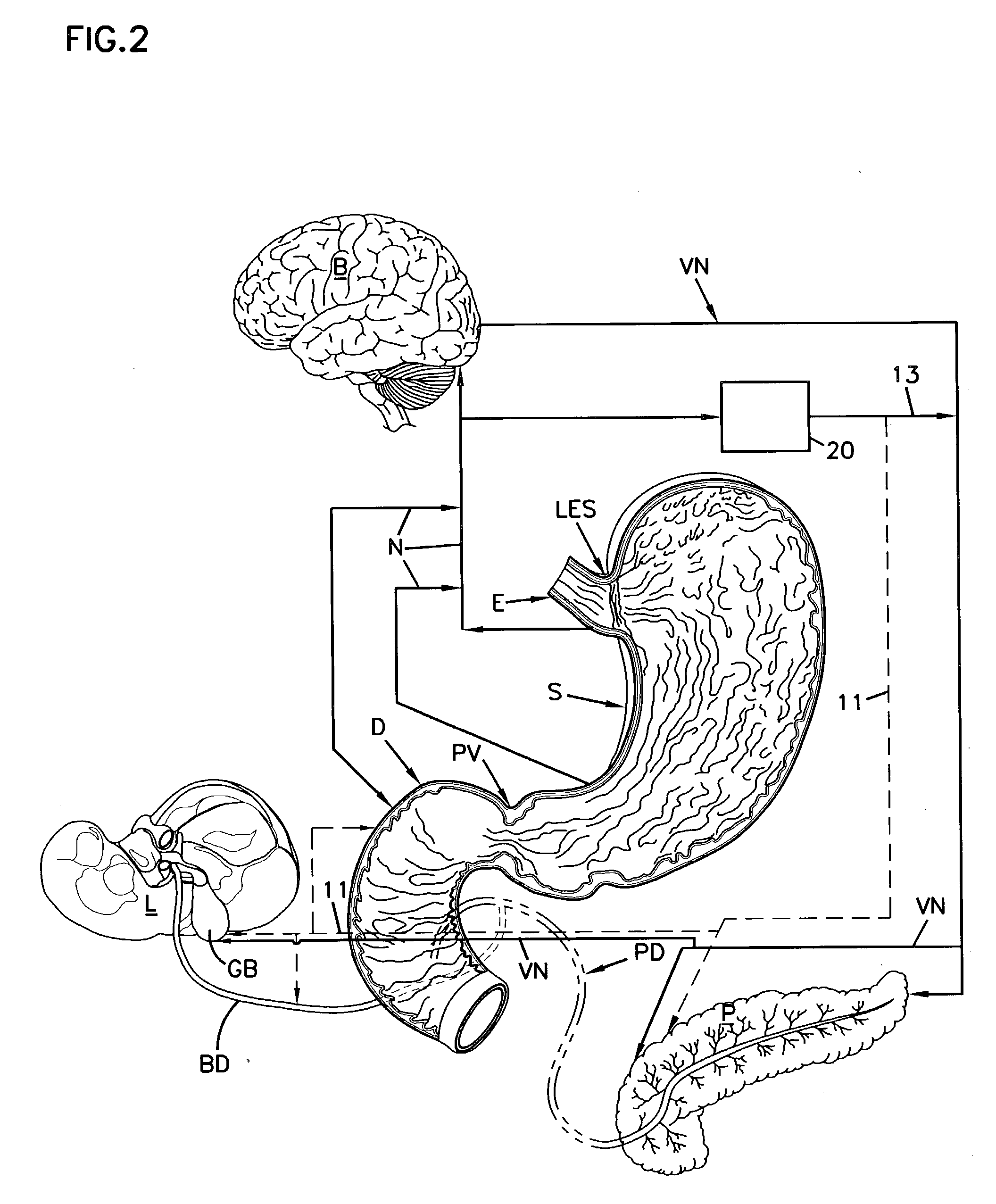 Method and apparatus for treatment of gastro-esophageal reflux disease (GERD)
