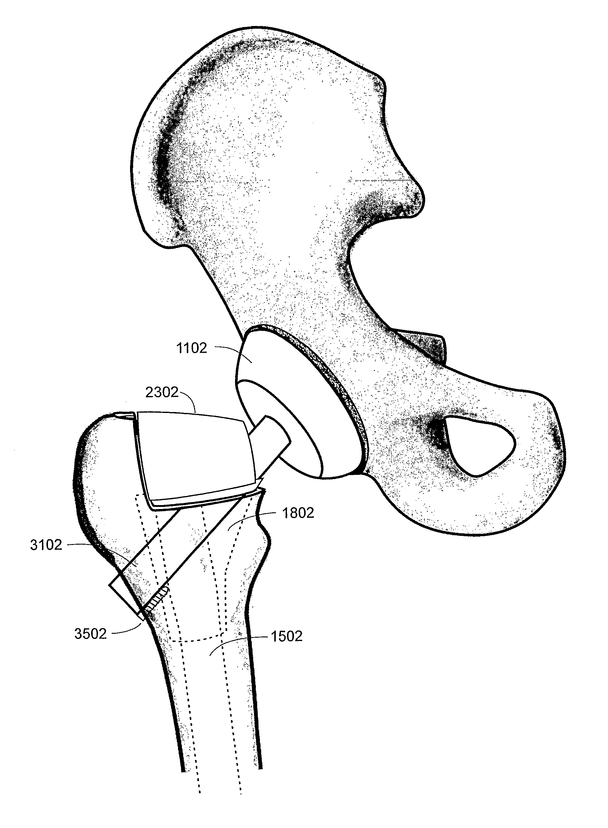 Method and apparatus for total hip replacement