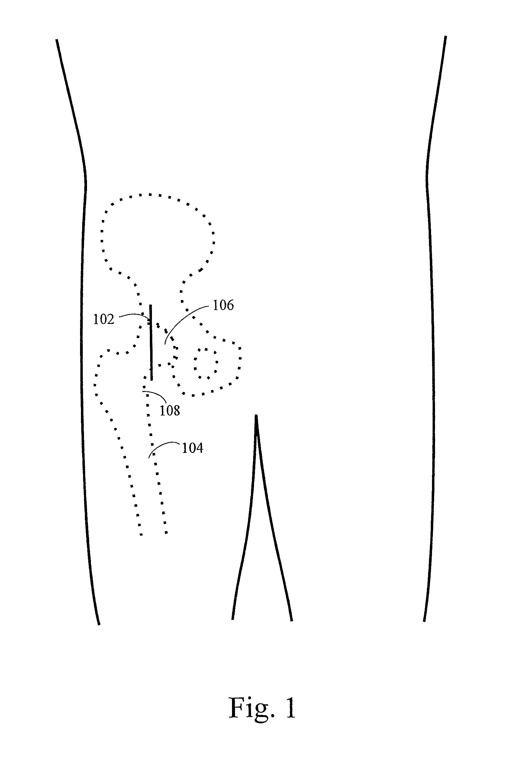 Method and apparatus for total hip replacement