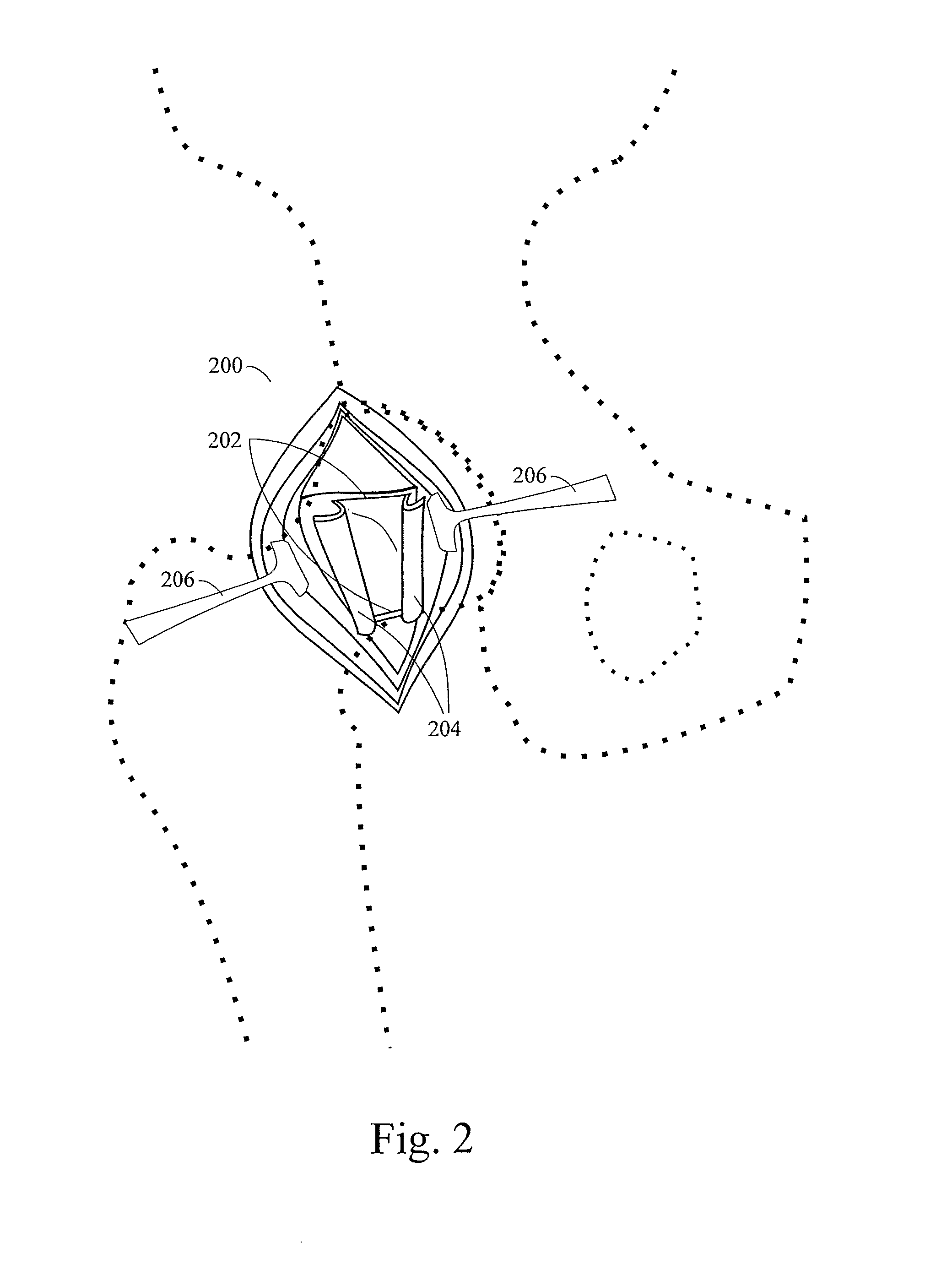 Method and apparatus for total hip replacement