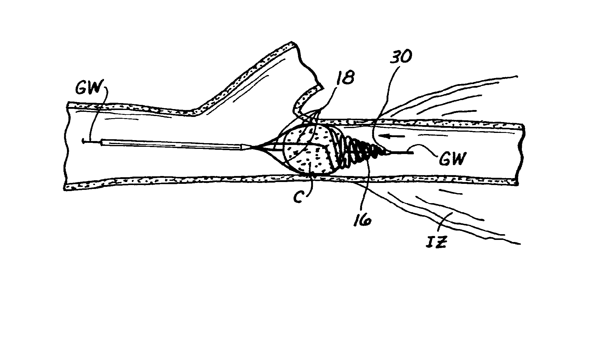 Embolectomy Catheters And Methods For Treating Stroke And Other Small Vessel Thromboembolic Disorders
