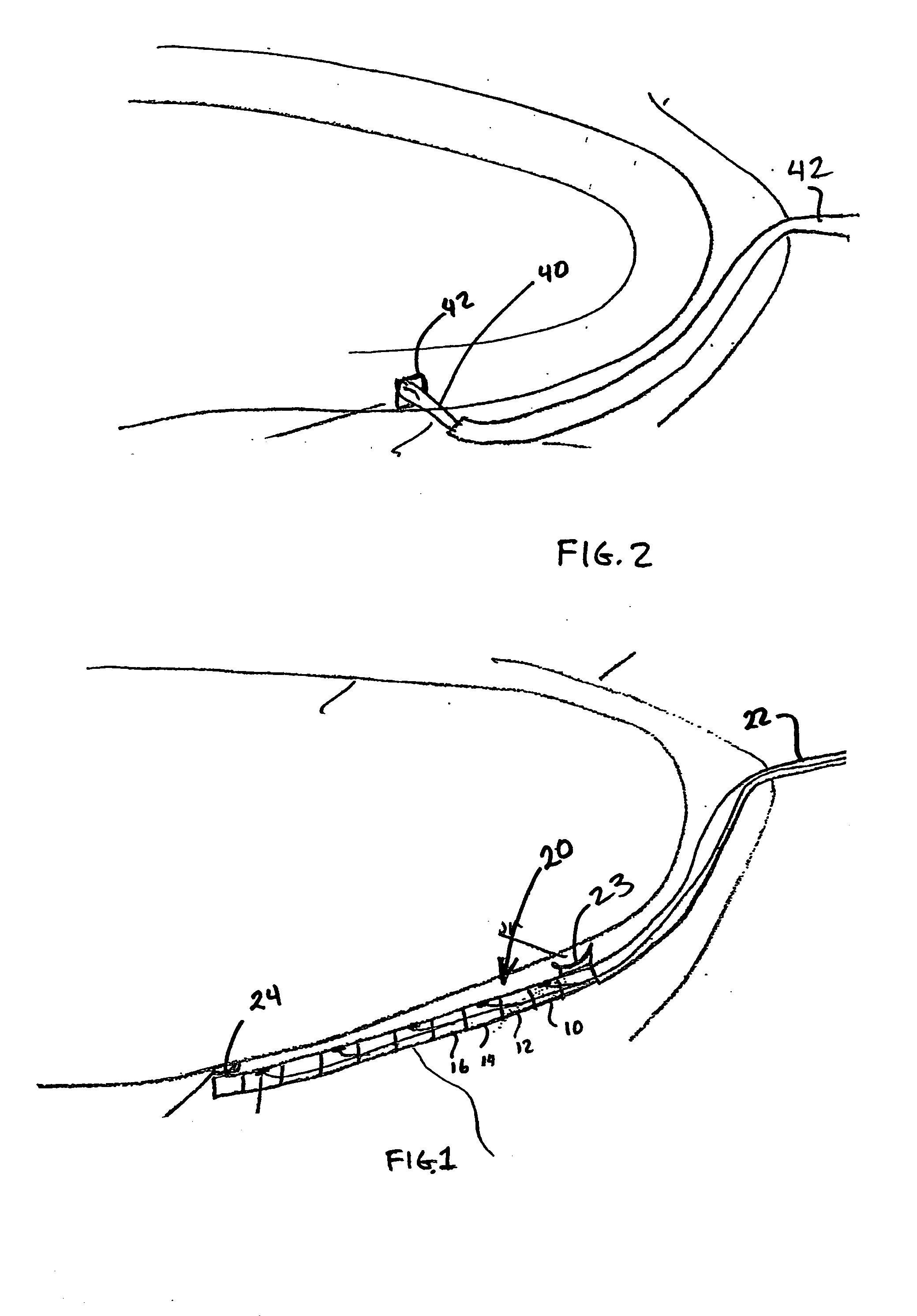 Perficardial pacing lead placement device and method