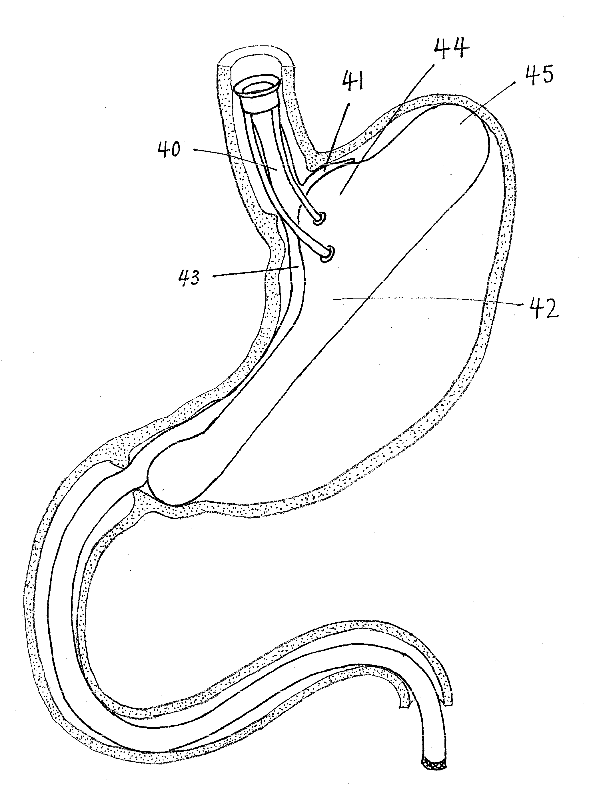 Intragastric Implant Devices