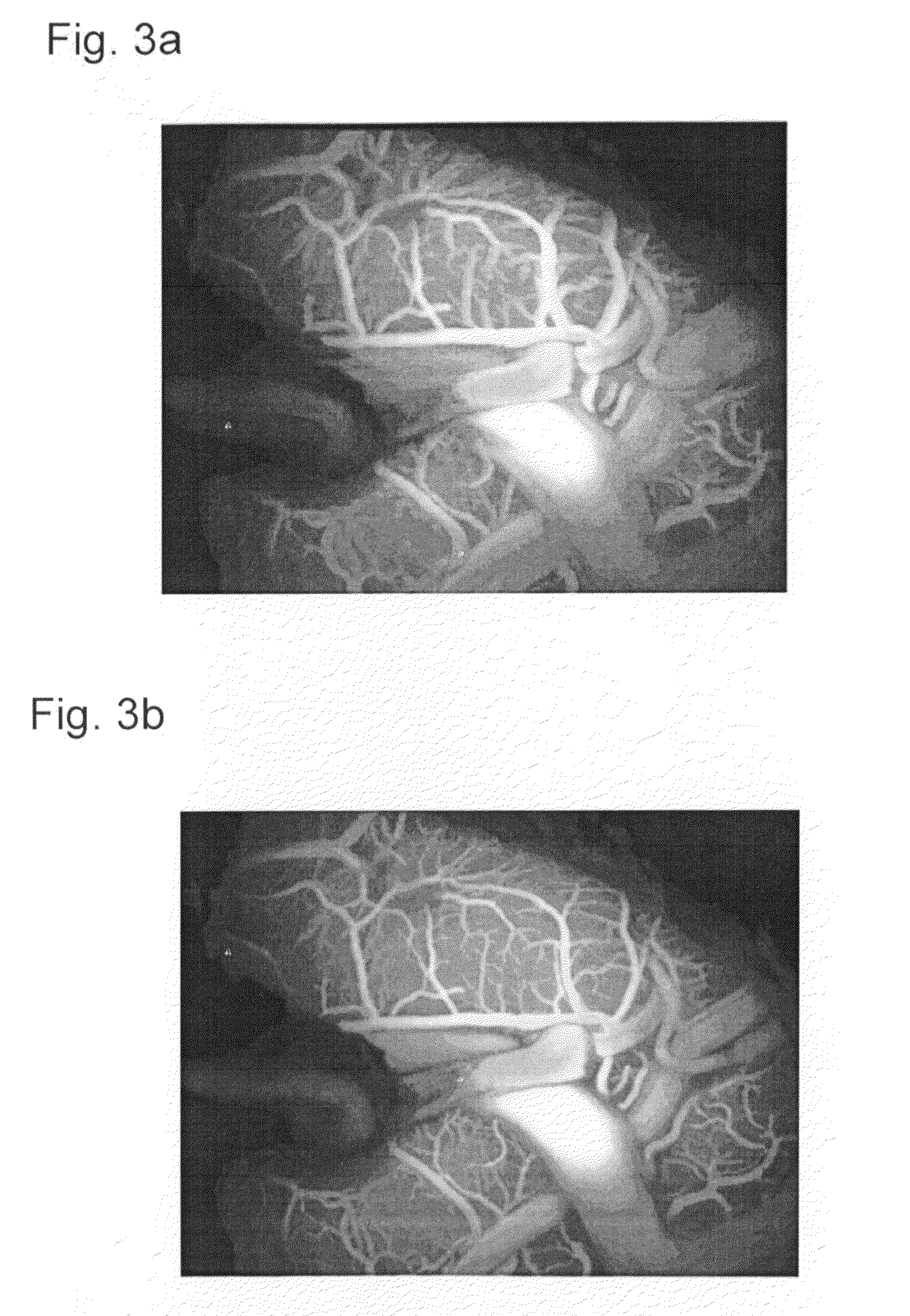 Method for the quantitative display of blood flow
