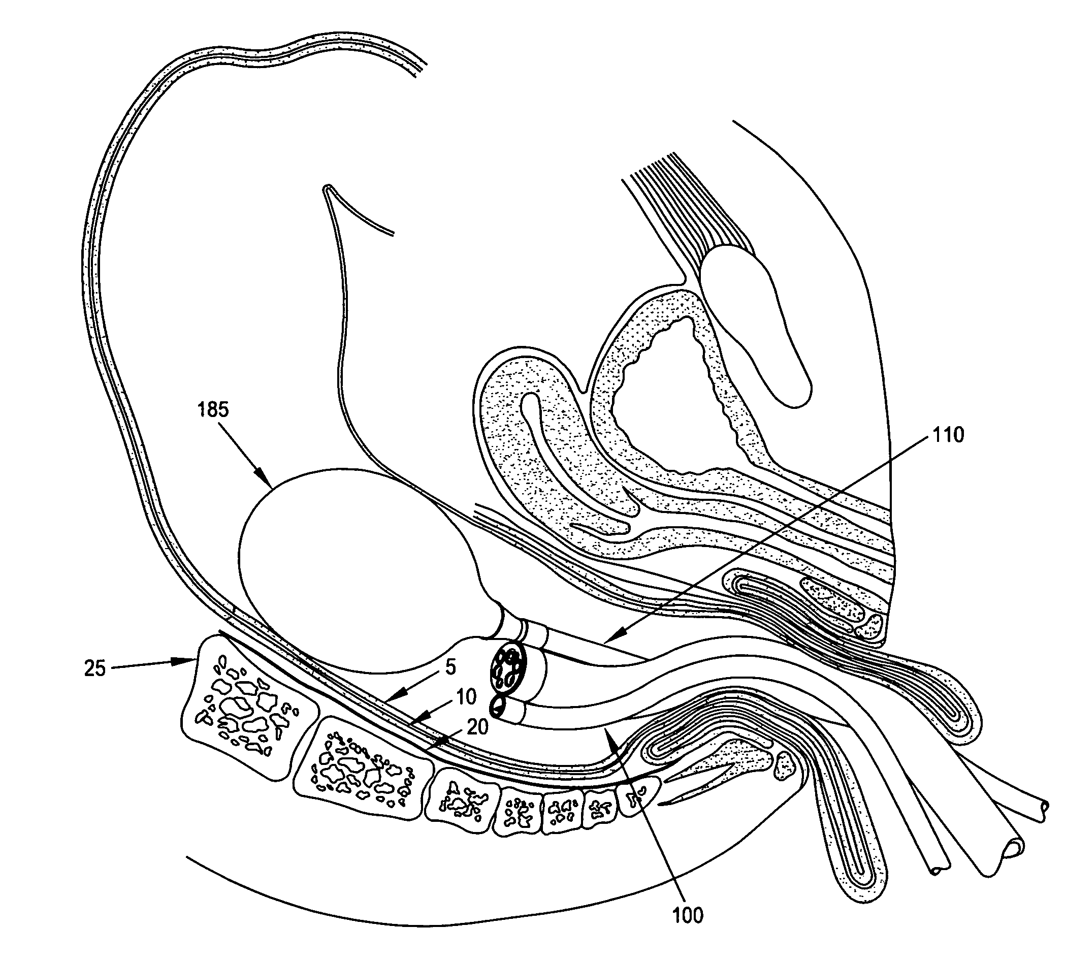 Method and apparatus for endoscopically treating rectal prolapse