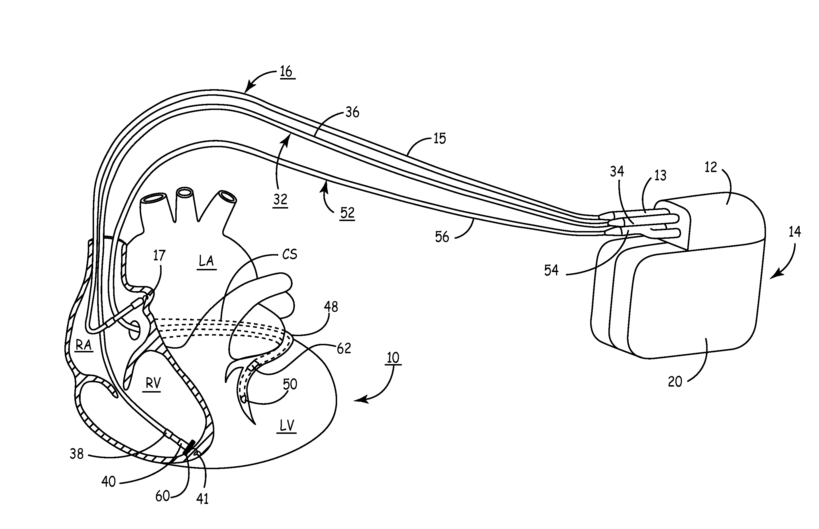 System and method for conditional biventricular pacing
