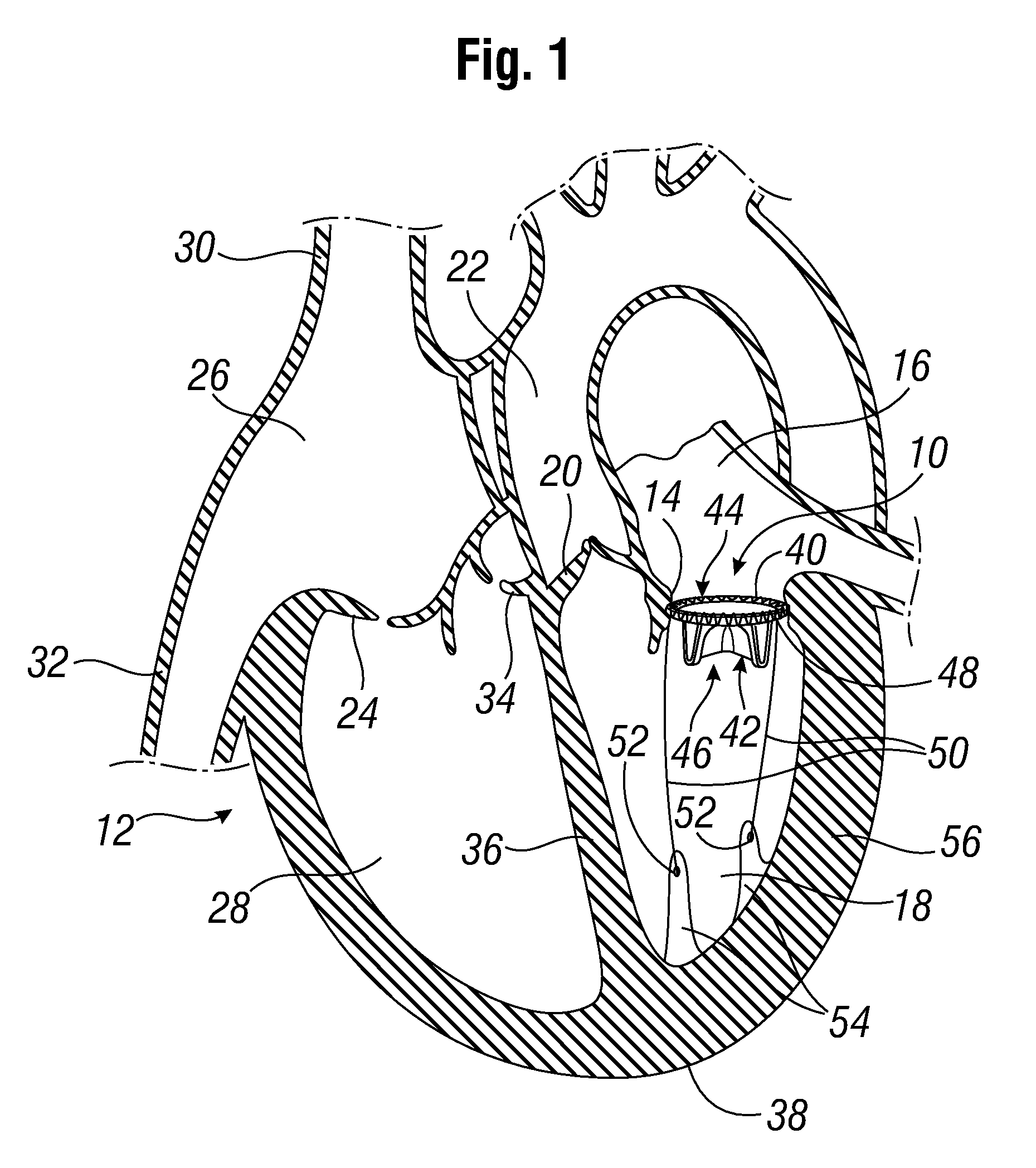 Prosthetic valve with ventricular tethers