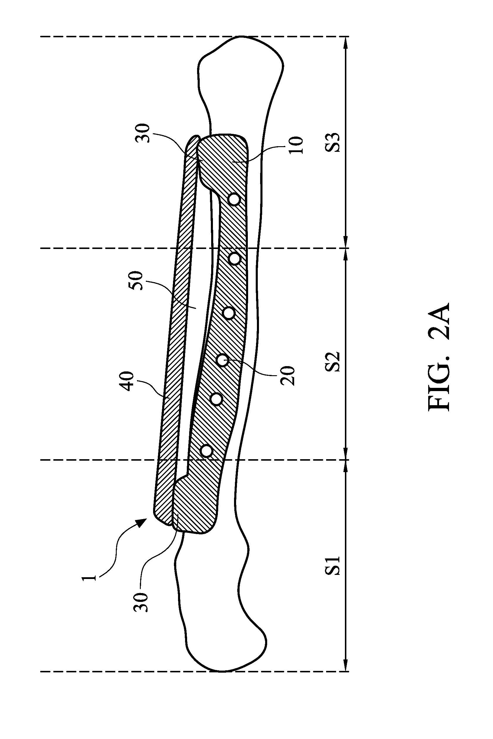 Three-dimensional fracture fixation device for nerve protection