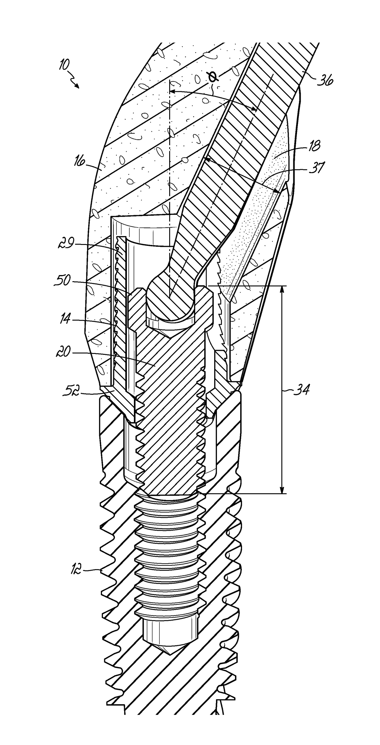 Screw-retained abutment with off-axis feature and methods of making and using same