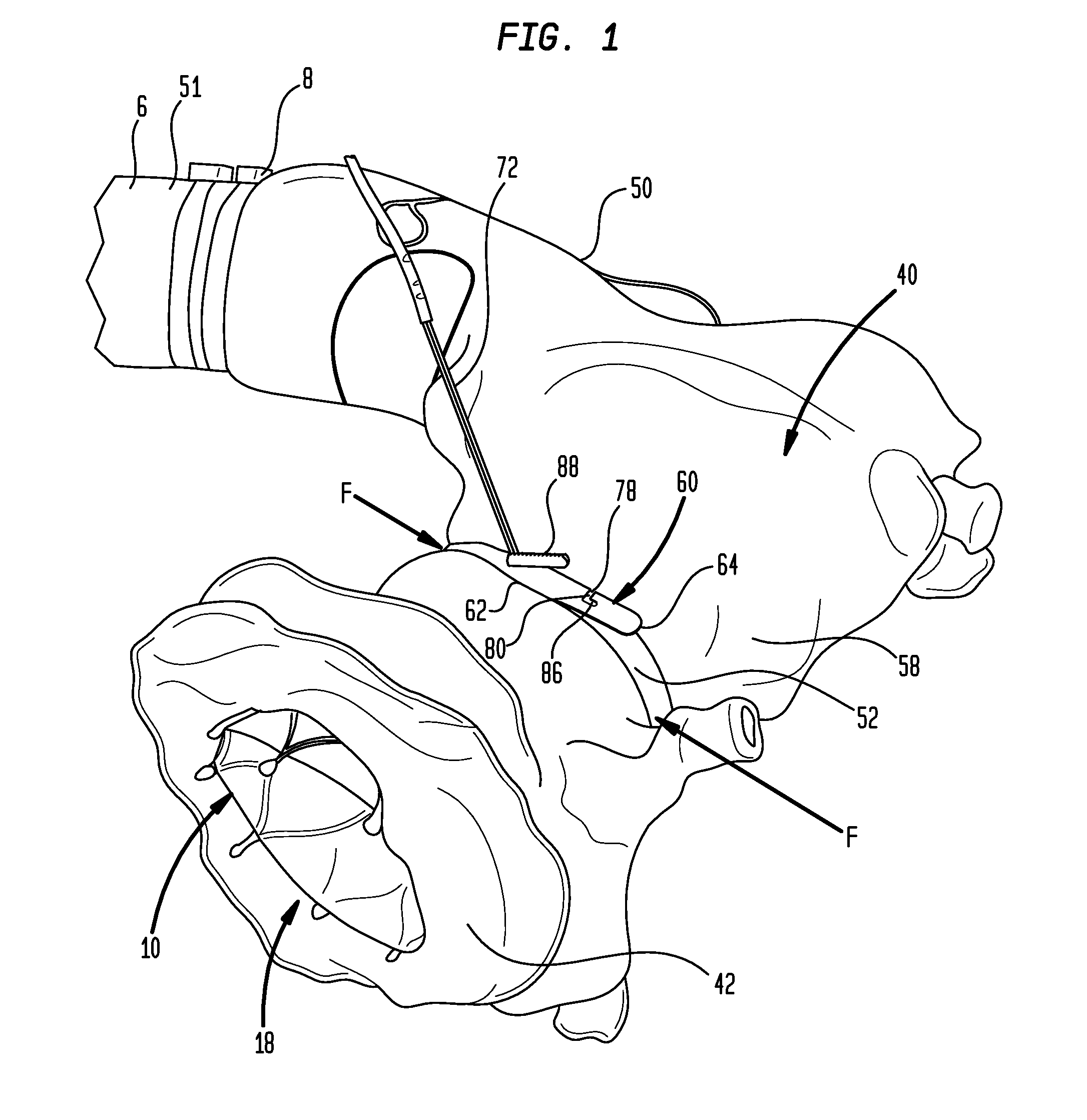 Aortic bands