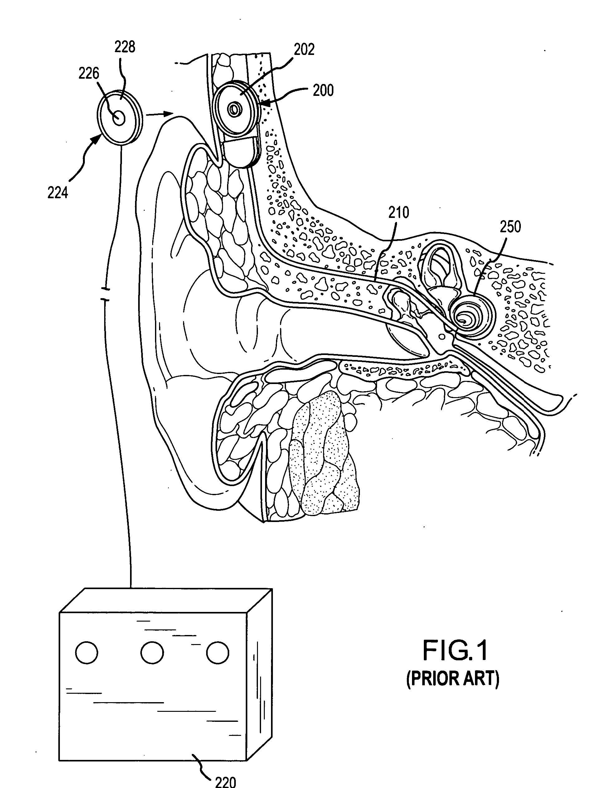 Integrated implantable hearing device, microphone and power unit
