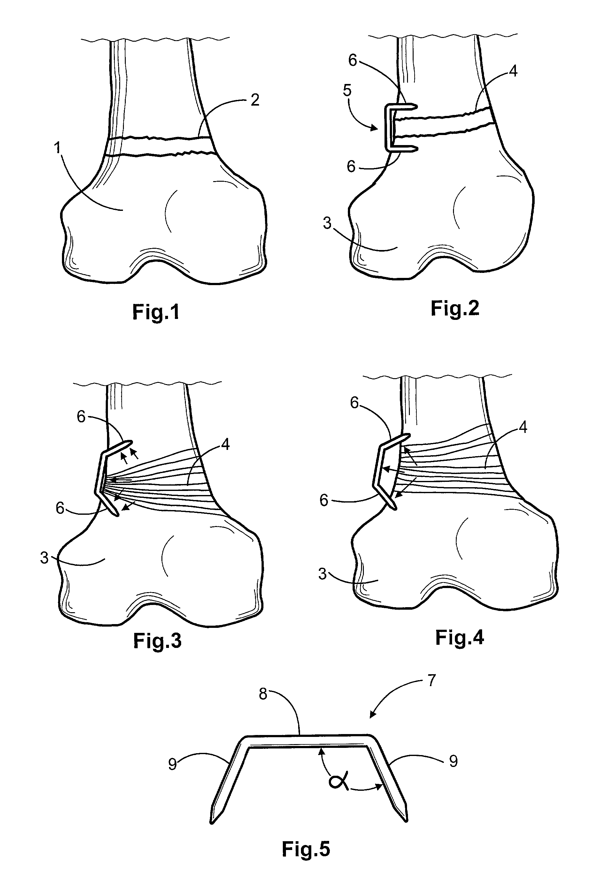 Bone staple and methods for correcting bone deficiencies by controllably suppressing and/or inducing the growth of the epiphyseal plate
