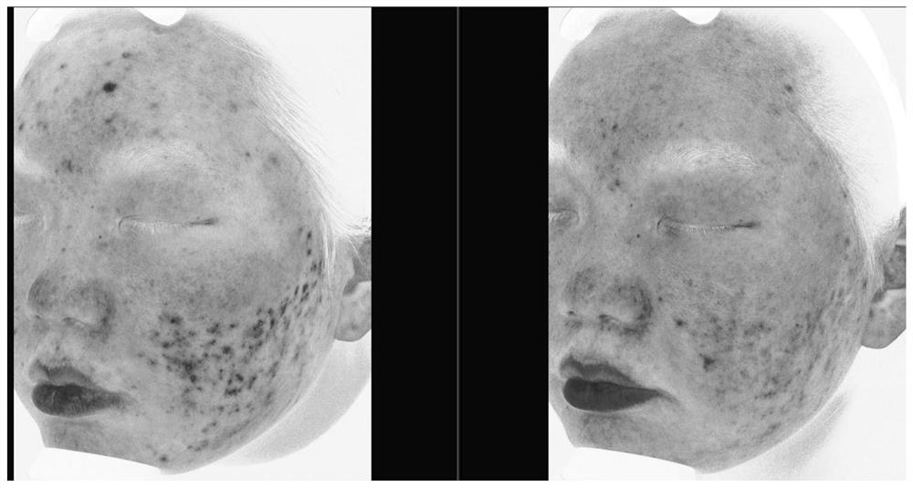 Transdermal drug delivery composition for treating acne and preparation method thereof