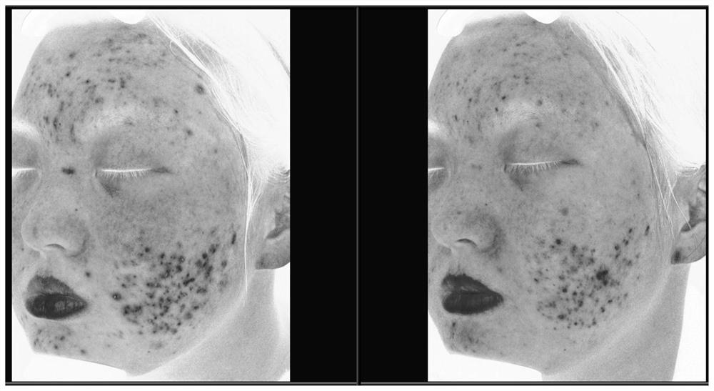 Transdermal drug delivery composition for treating acne and preparation method thereof