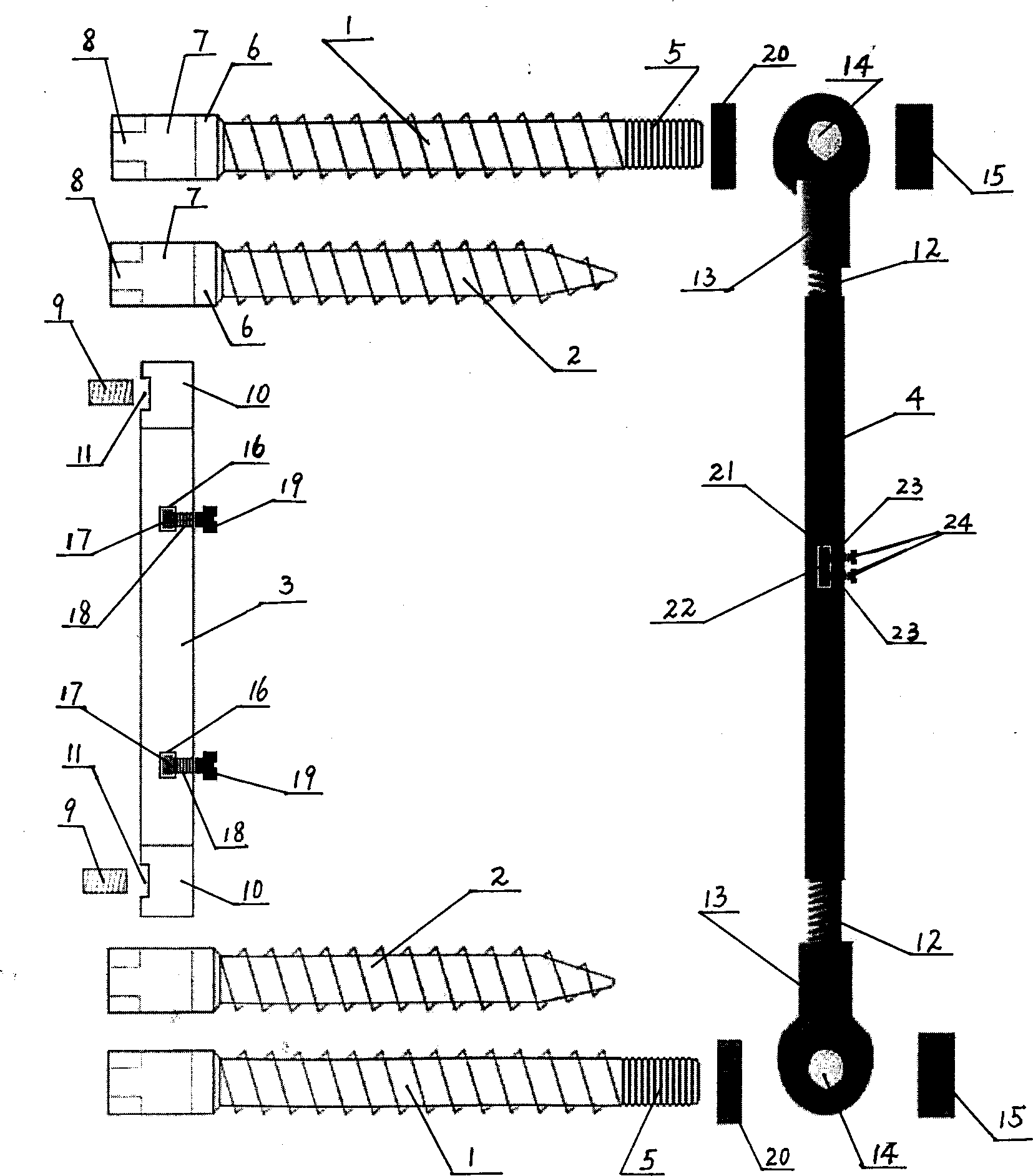 Front thoracolumbar fixing system via pedicle of vertebral arch