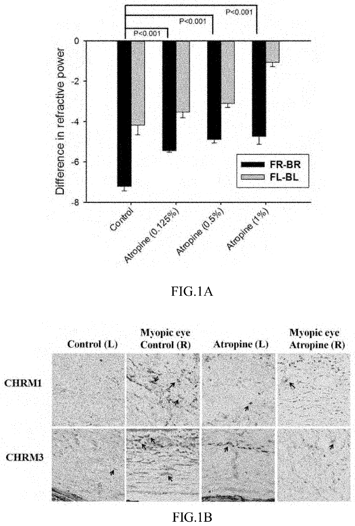 Method for treating and relieving myopia