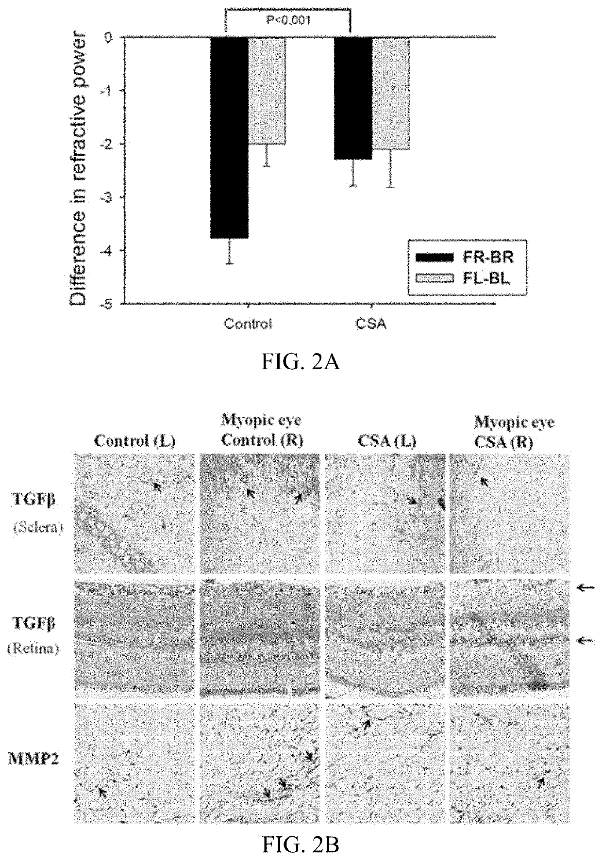 Method for treating and relieving myopia