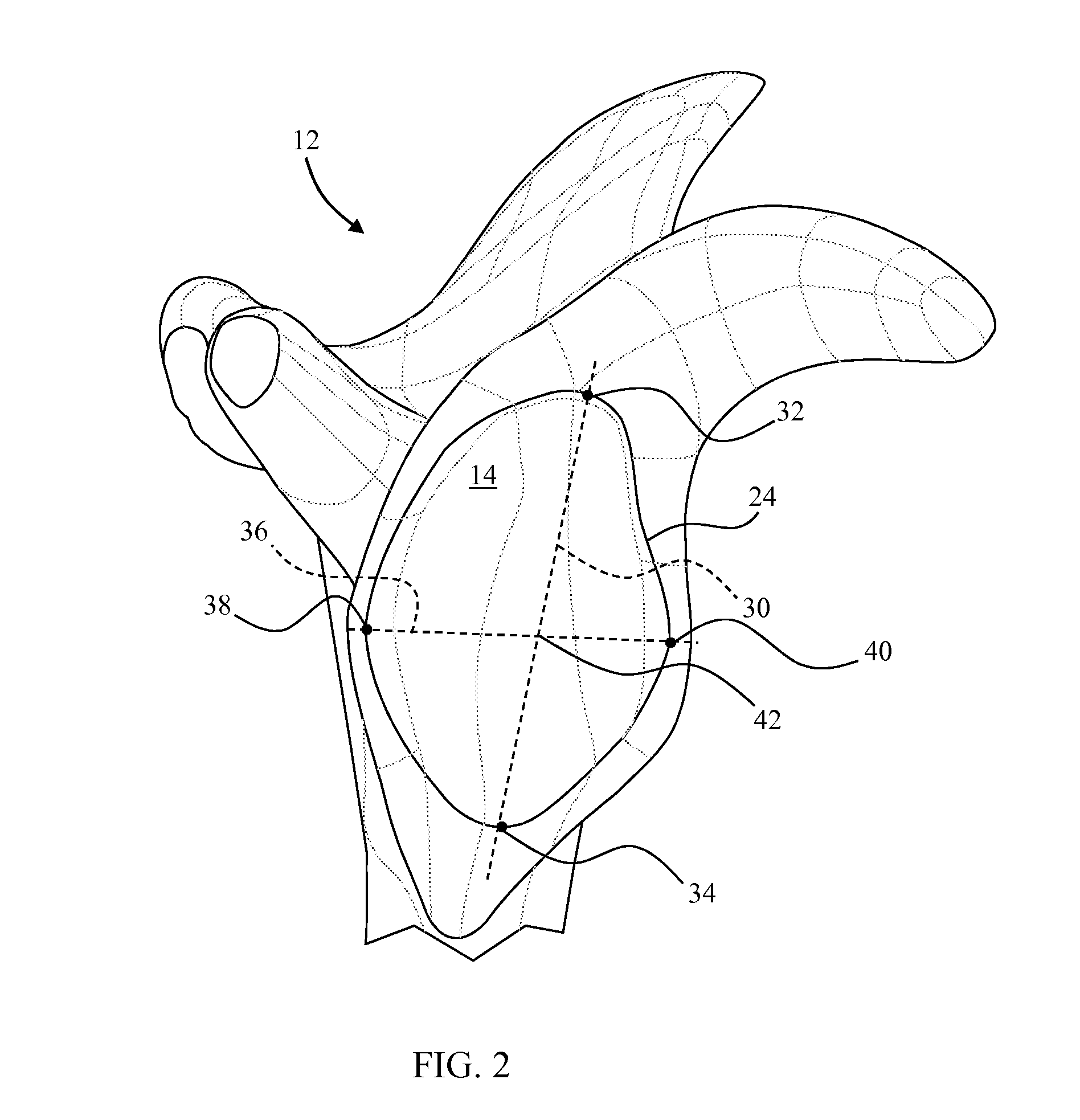 Device and Method for Retroversion Correction for Shoulder Arthroplasty