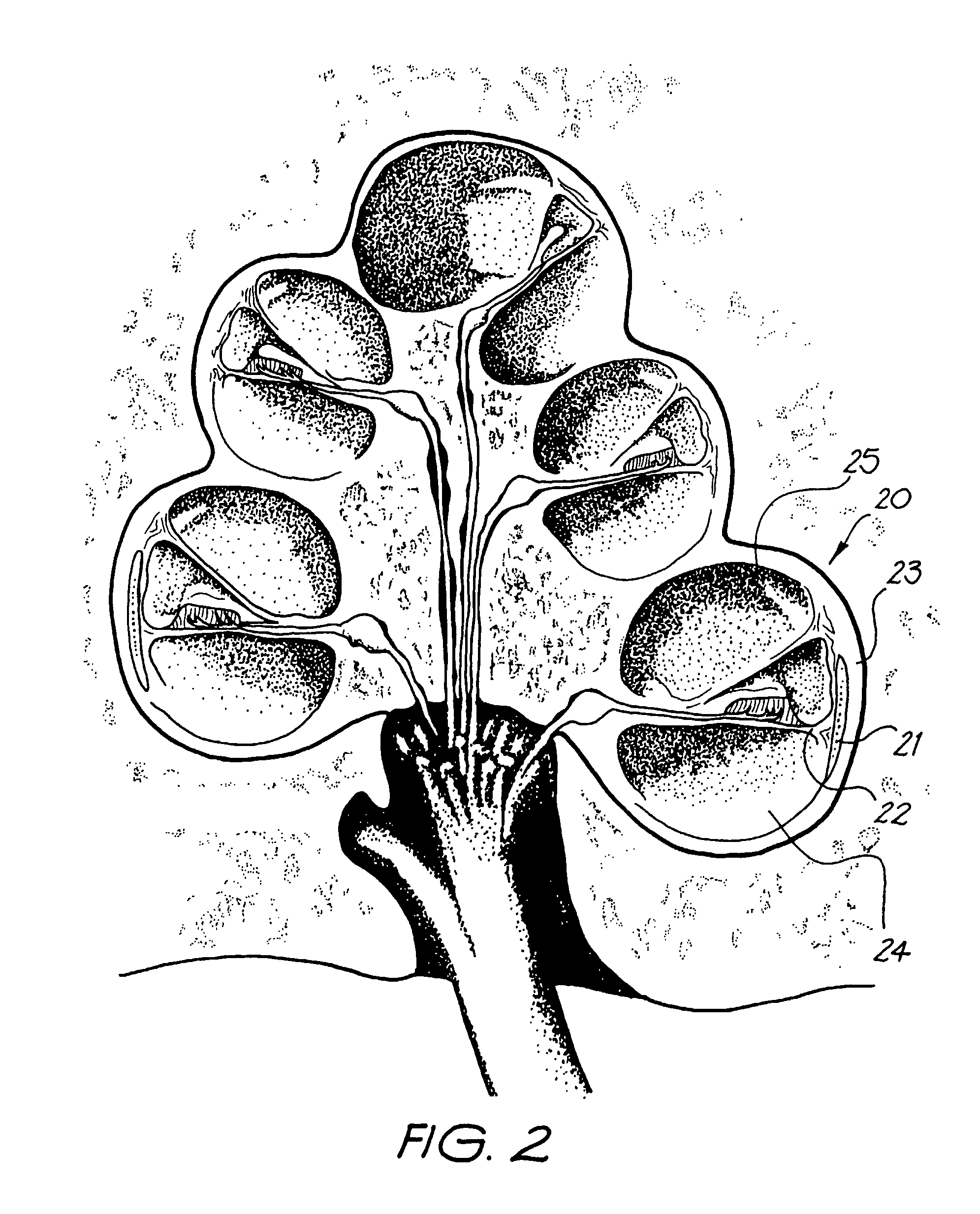 Endosteal electrode