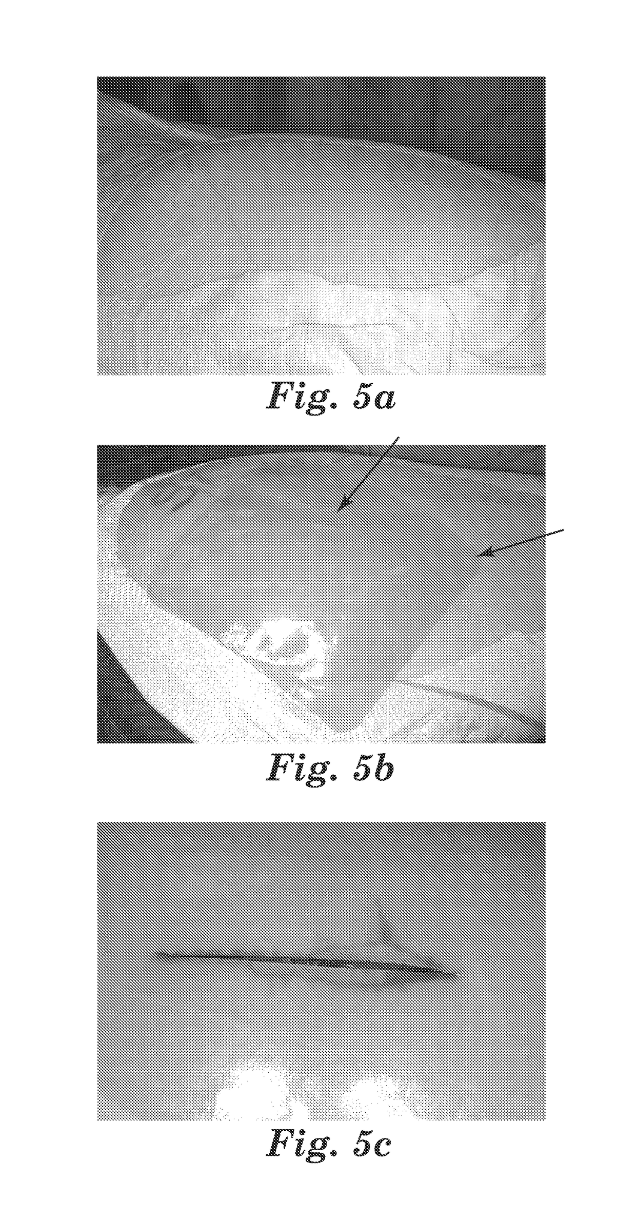 Methods and products for reducing tissue trauma using water-absorbing stress-distributing materials