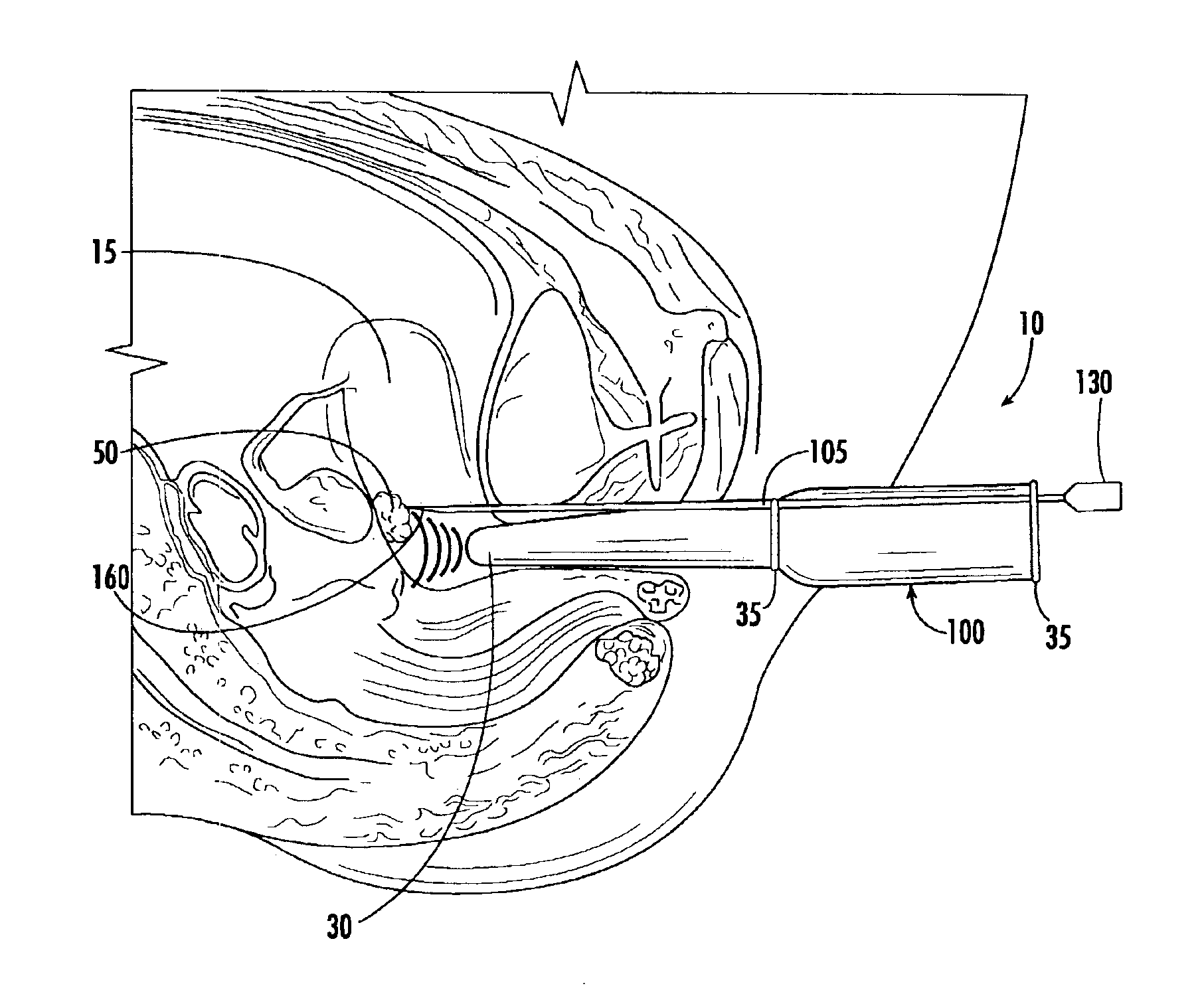 Echogenic needle for transvaginal ultrasound directed reduction of uterine fibroids and an associated method