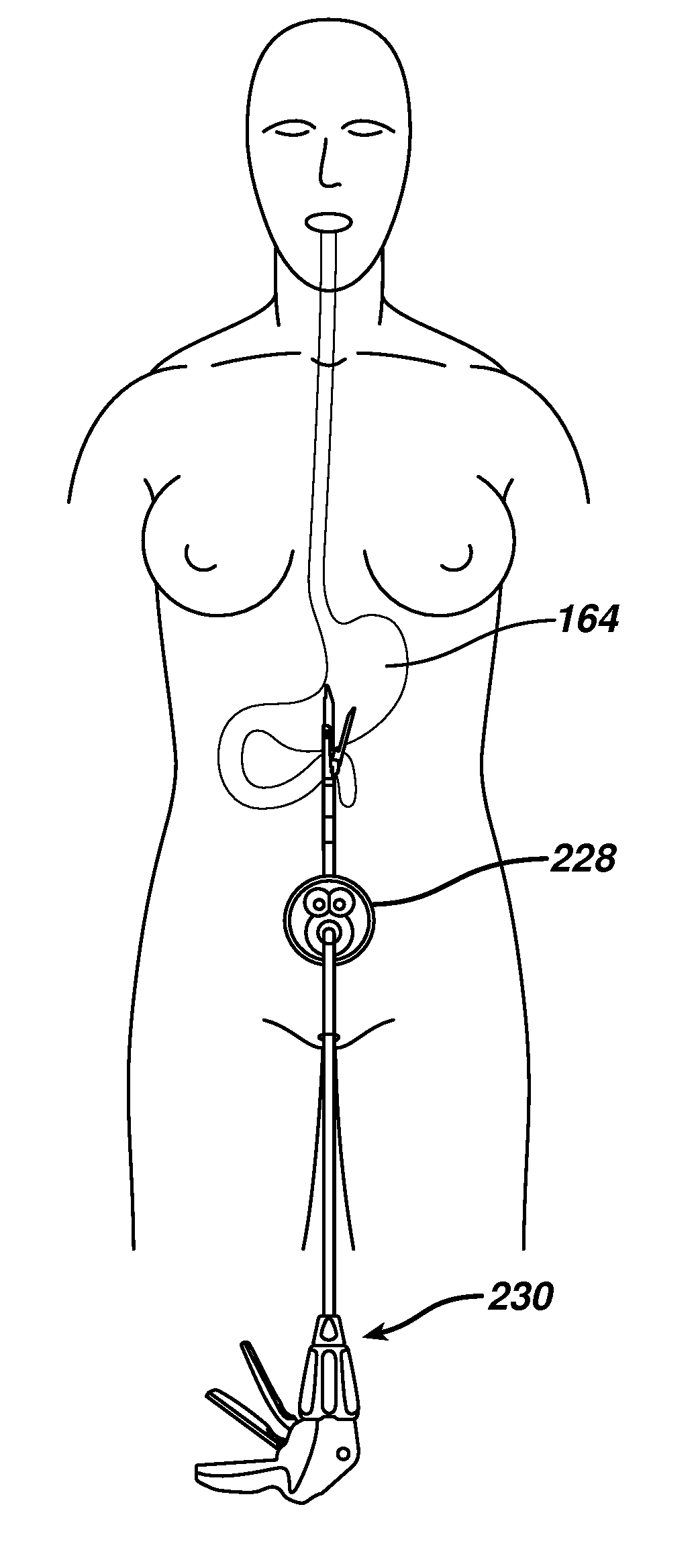Methods and devices for performing gastrectomies and gastroplasties