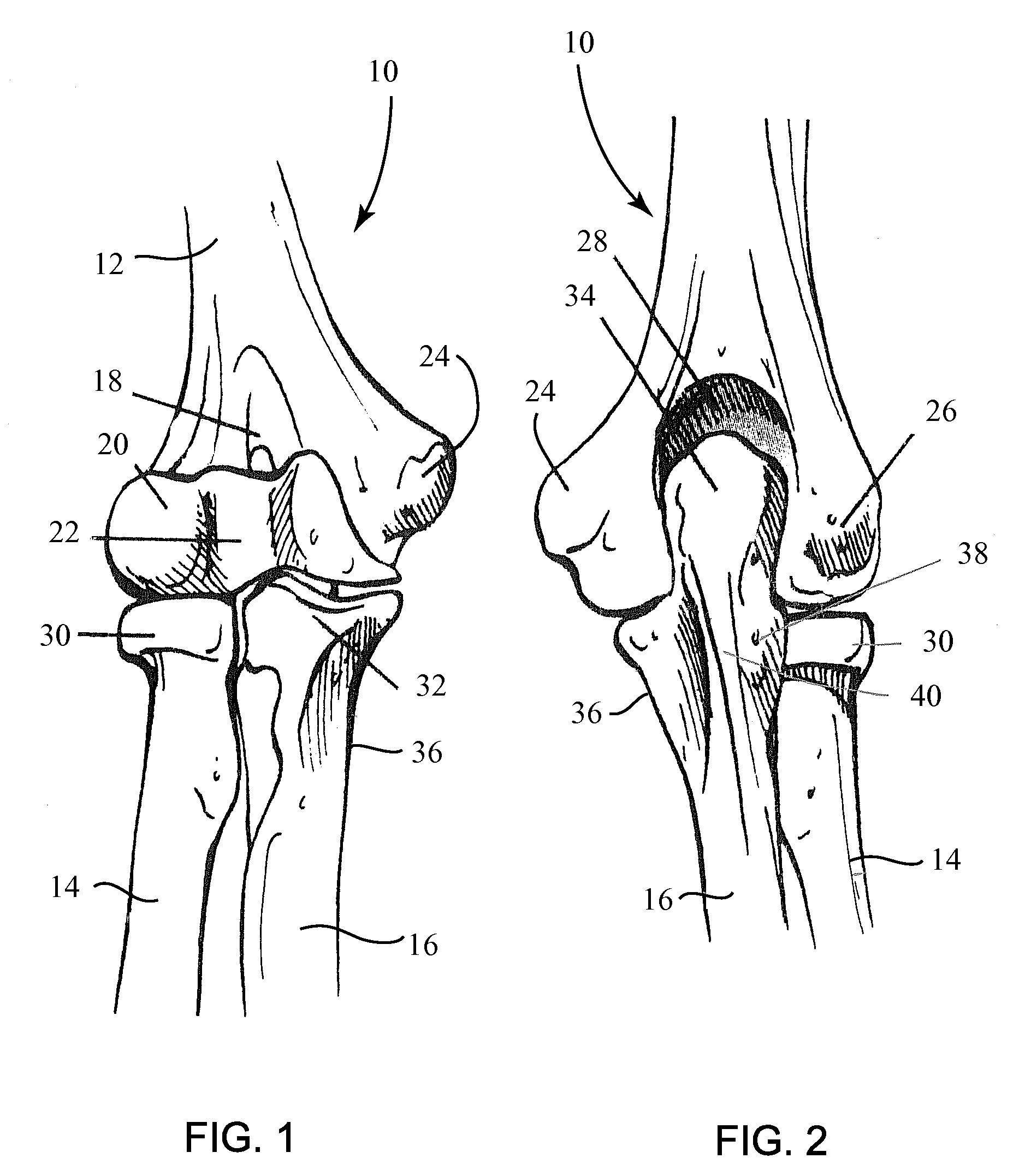 Fracture Fixation Plate for the Proximal Radius