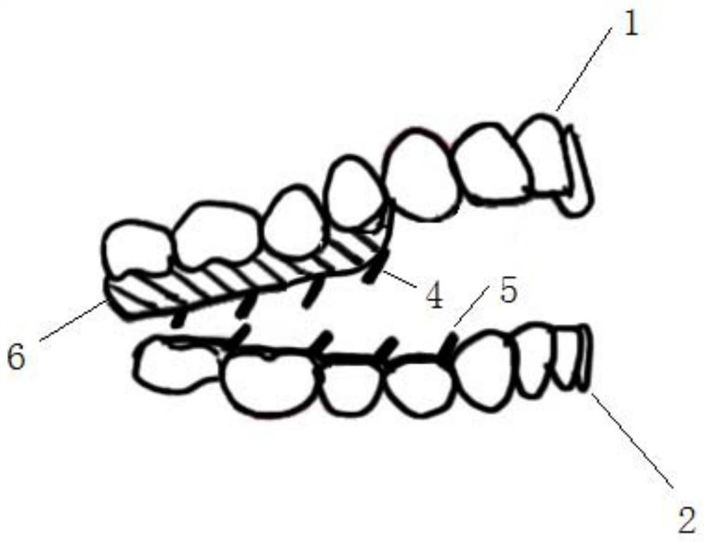 Tongue force occlusal force mediated invisible orthodontic device and manufacturing method