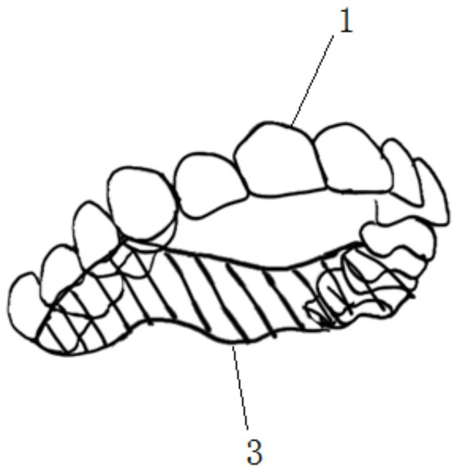 Tongue force occlusal force mediated invisible orthodontic device and manufacturing method
