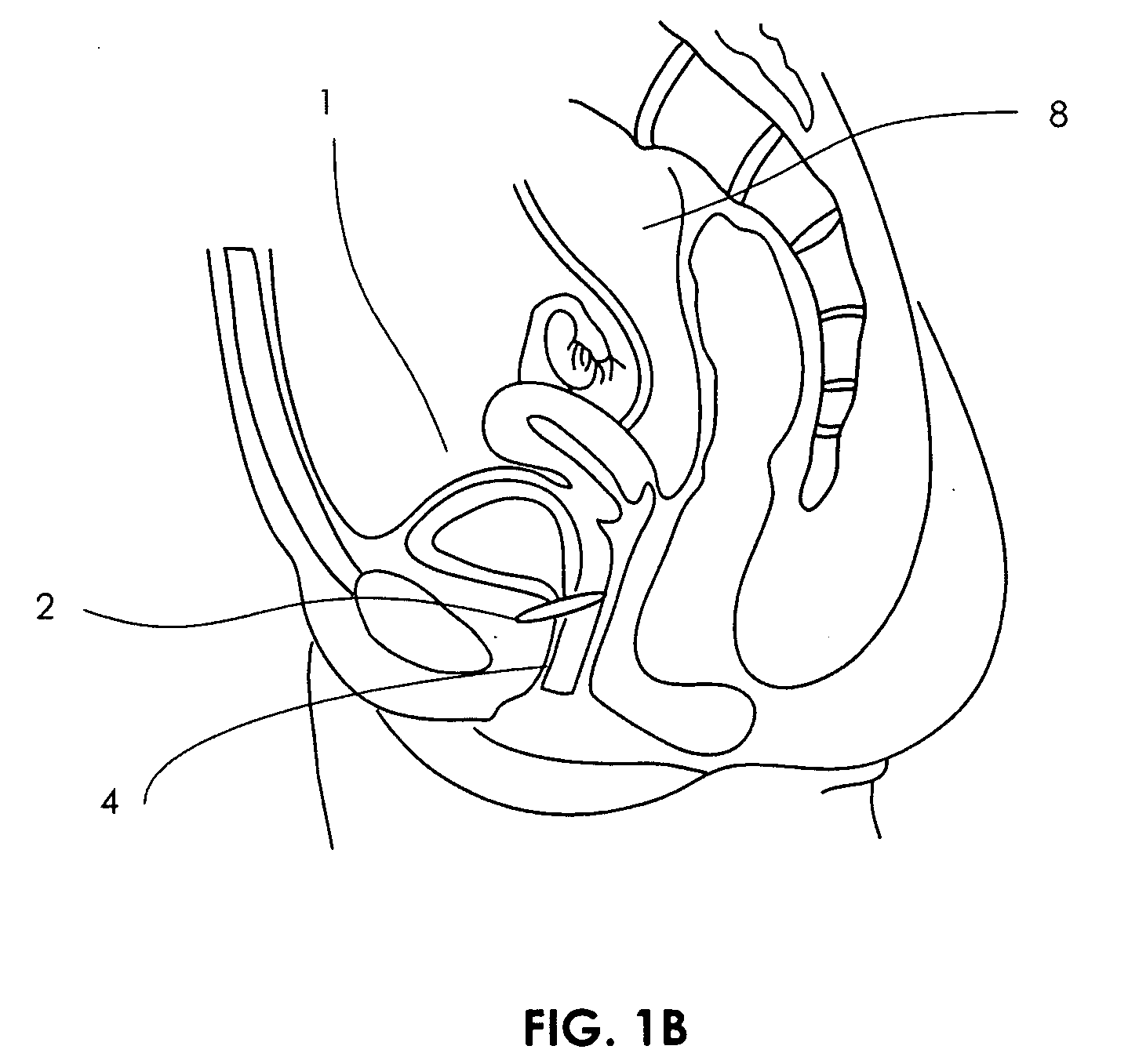 Artificial sphincter with piezoelectric actuator