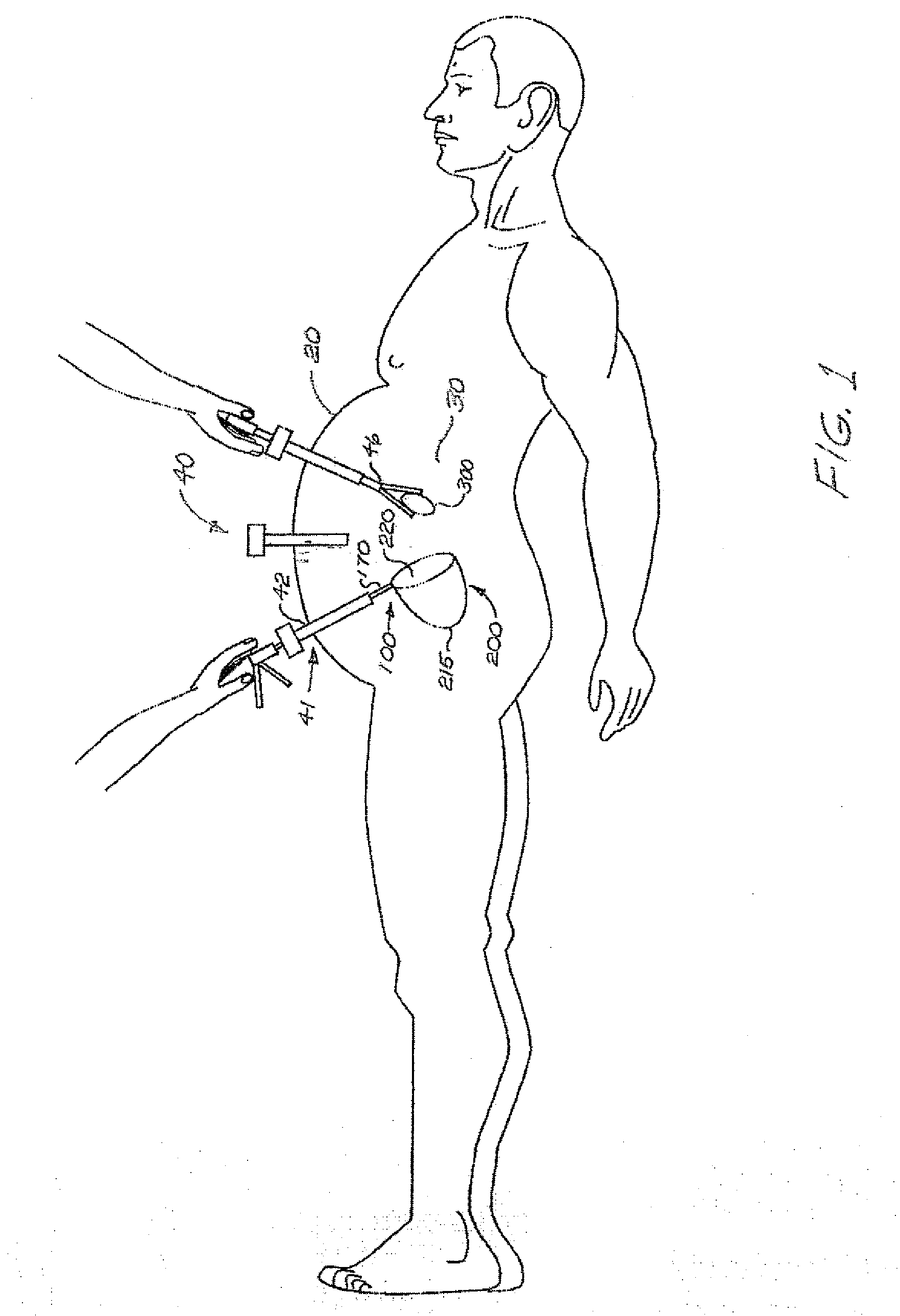 Device for isolating and removing tissue from a body cavity