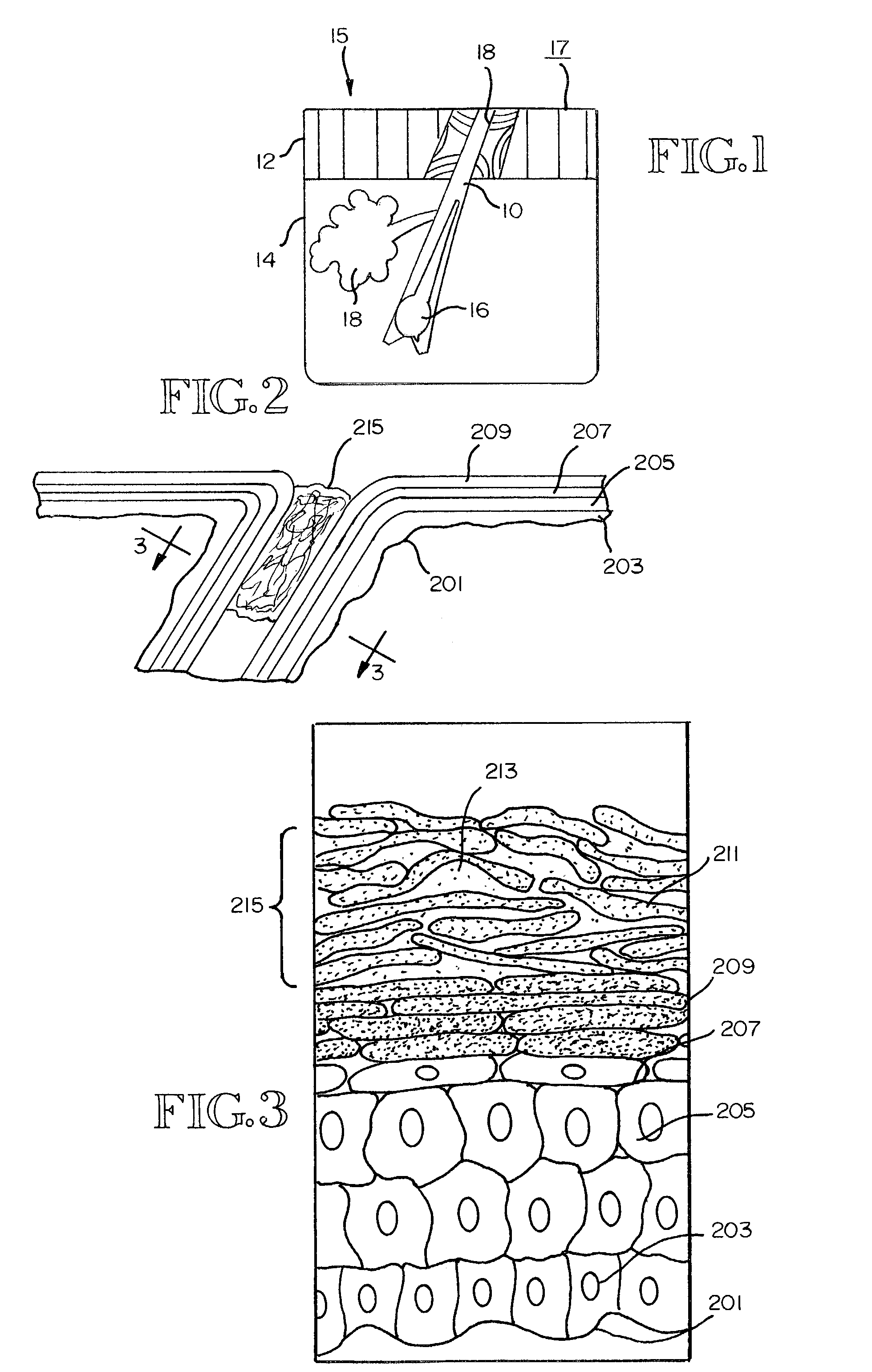 Apparatus and method for acoustic/mechanical treatment of early stage acne