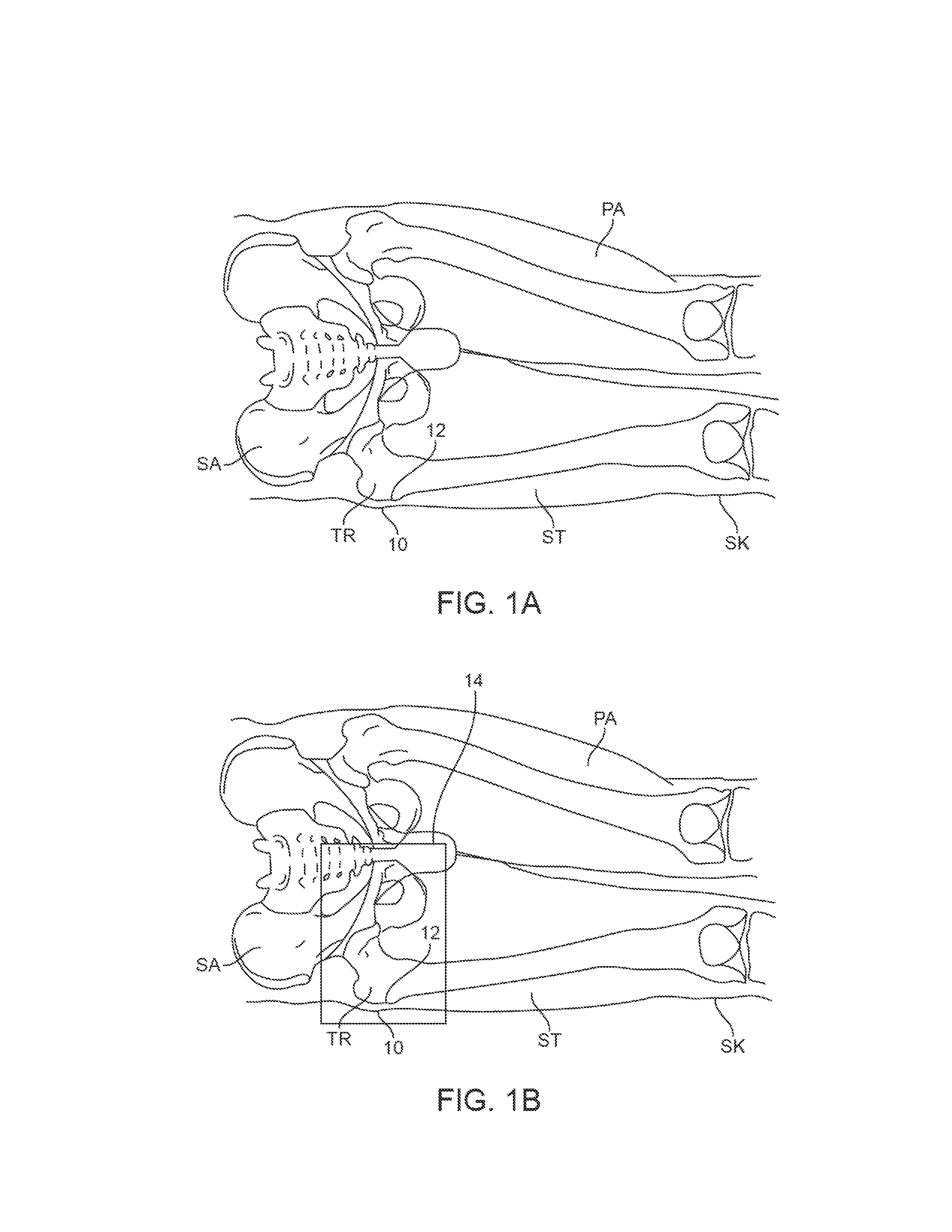 Method and devices for prevention and treatment of pressure ulcers