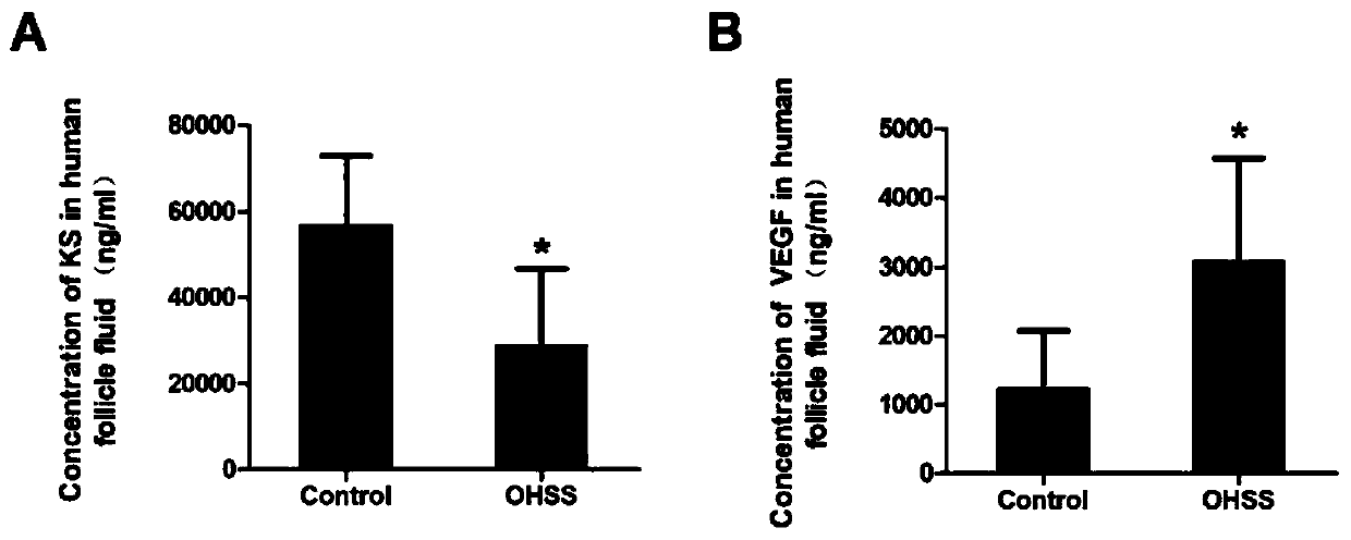 Ovarian hyperstimulation syndrome (OHSS) diagnostic marker Kallistatin and application thereof