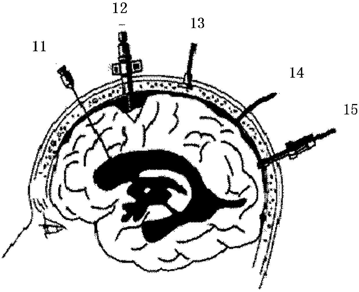 An implantable wireless passive intracranial pressure monitoring system