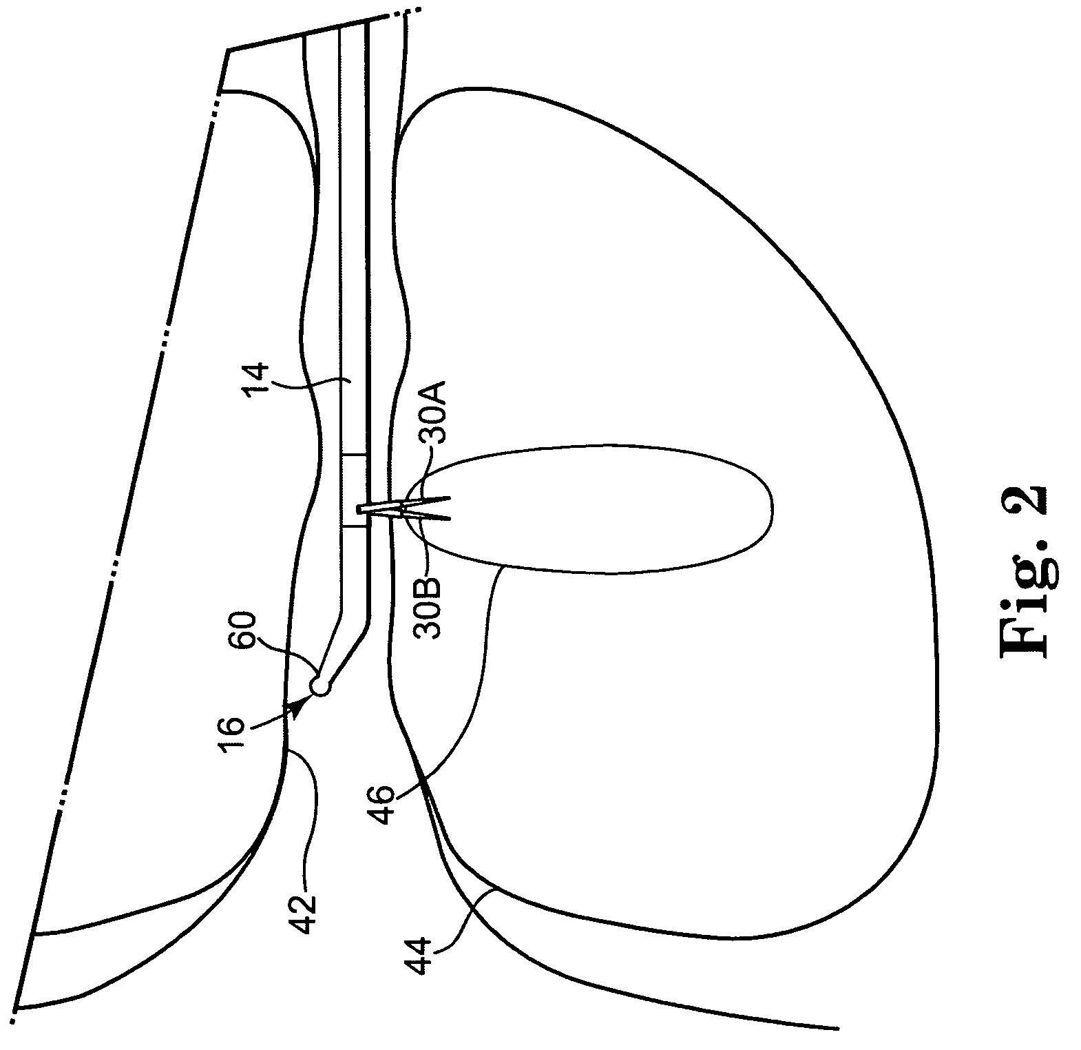 Transurethral needle ablation system