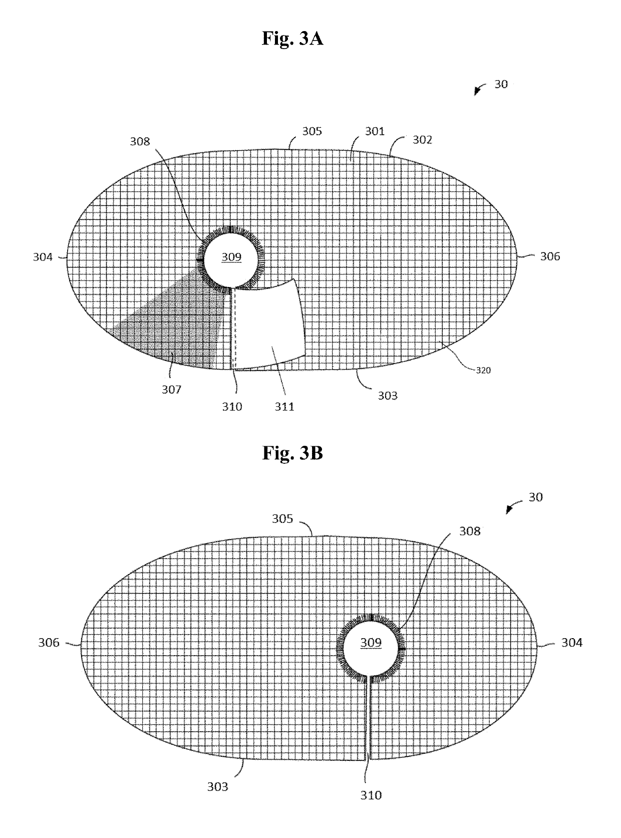 Gender-specific mesh implant with barrier for inguinal hernia repair