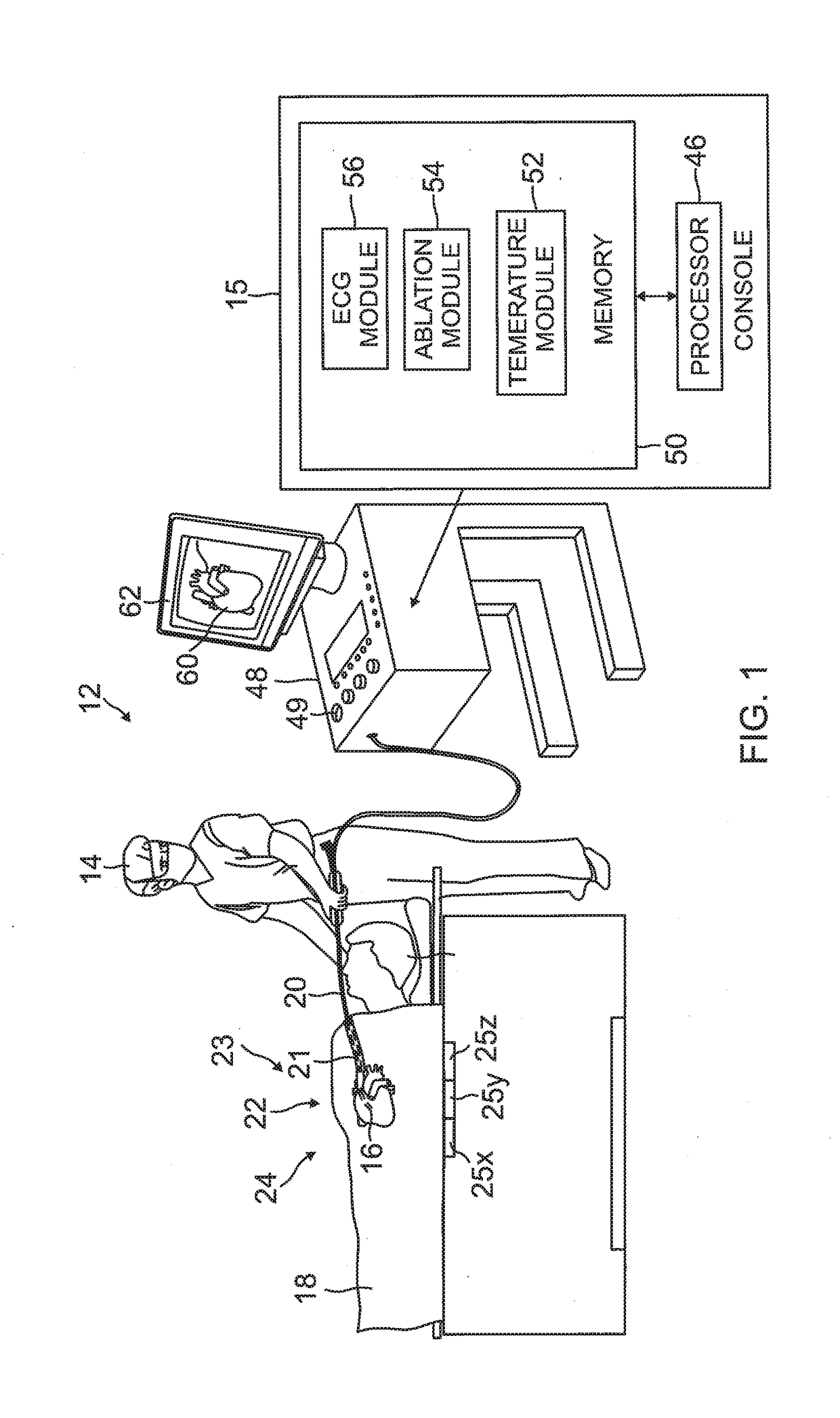 Irrigated balloon catheter with flexible circuit electrode assembly