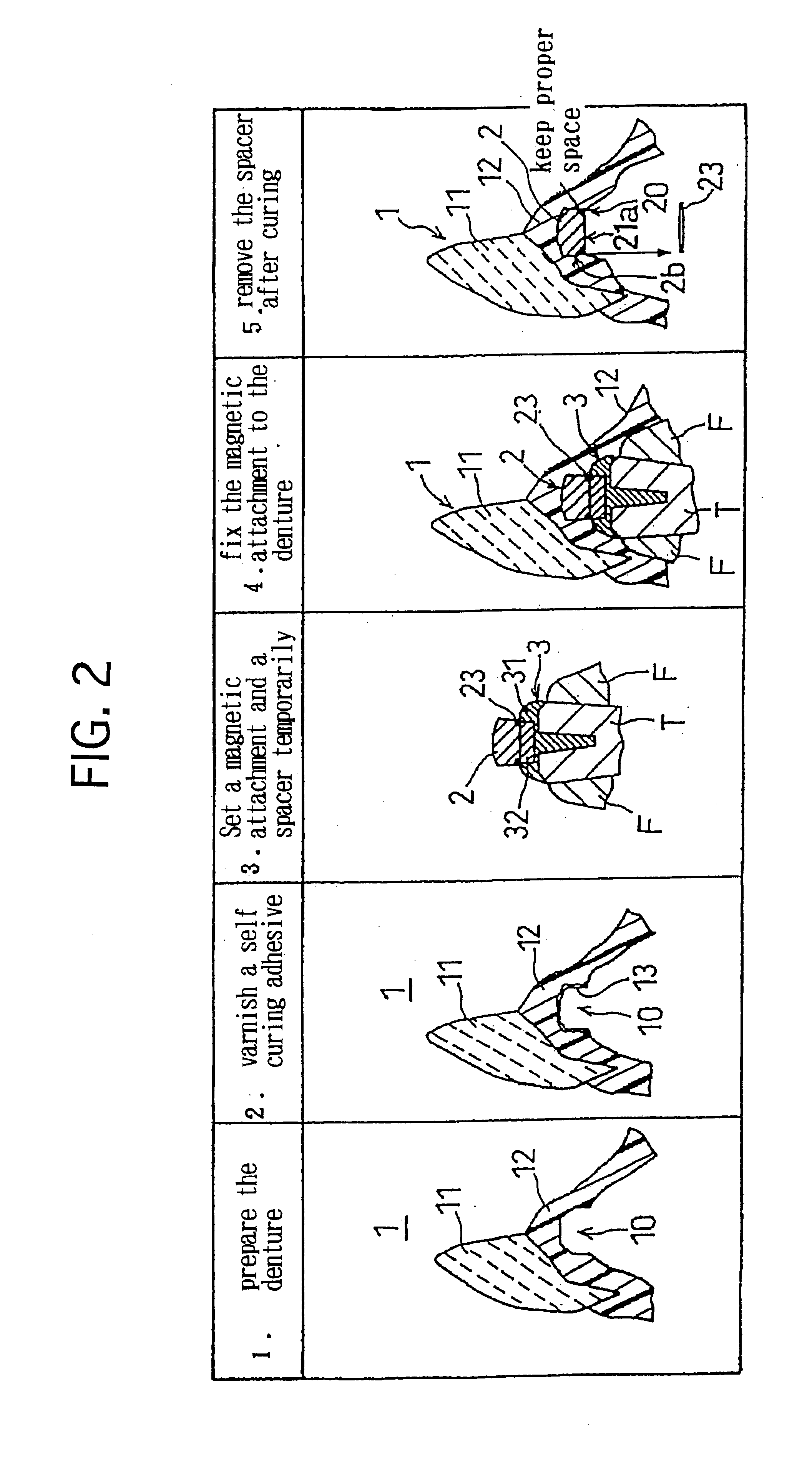 Dental magnetic attachment and its fixing method including spacer